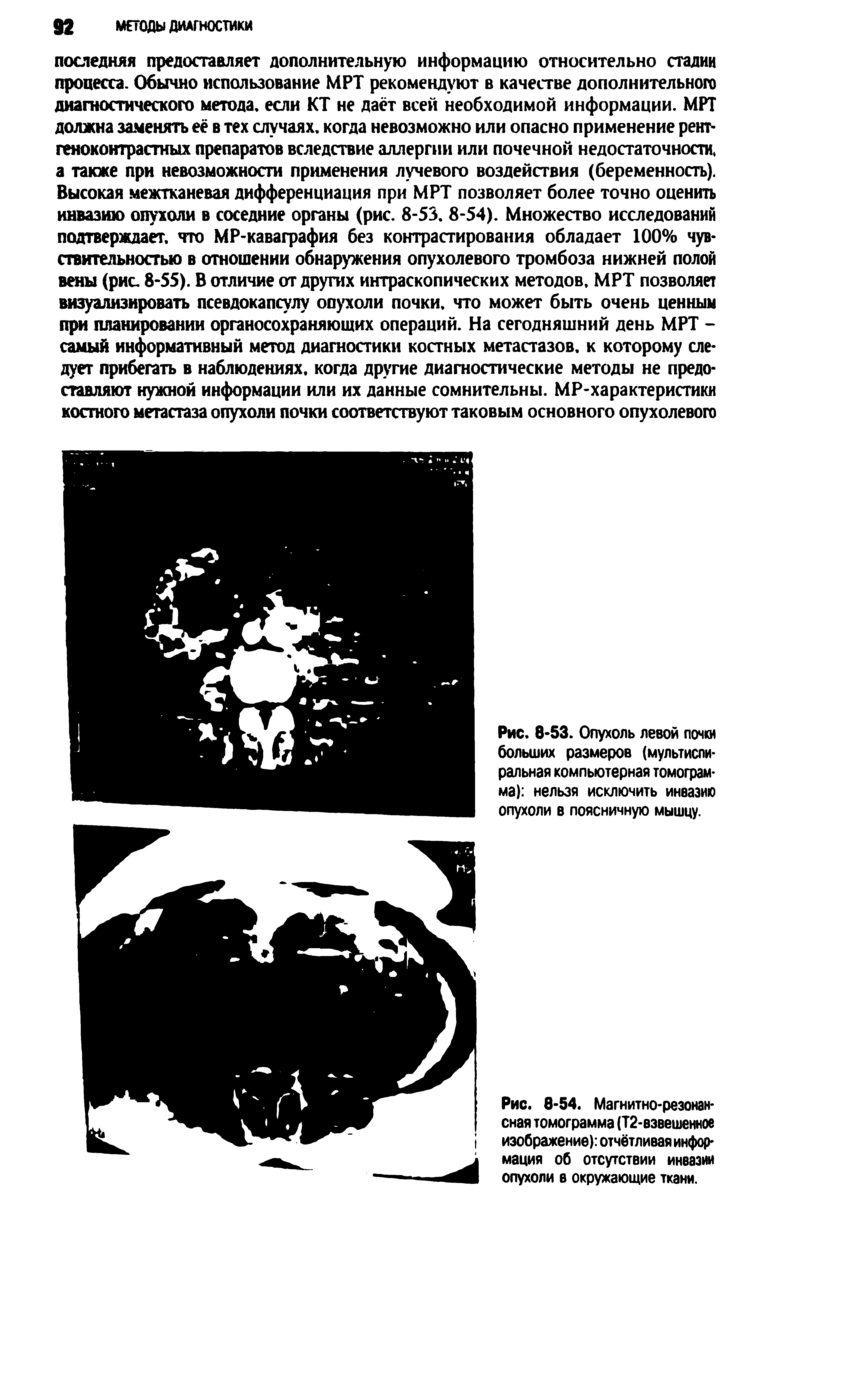 Рис. 8-54. Магнитно-резонансная томограмма (Т2-взвешенное изображение) отчётливая информация об отсутствии инвазии опухоли в окружающие ткани.