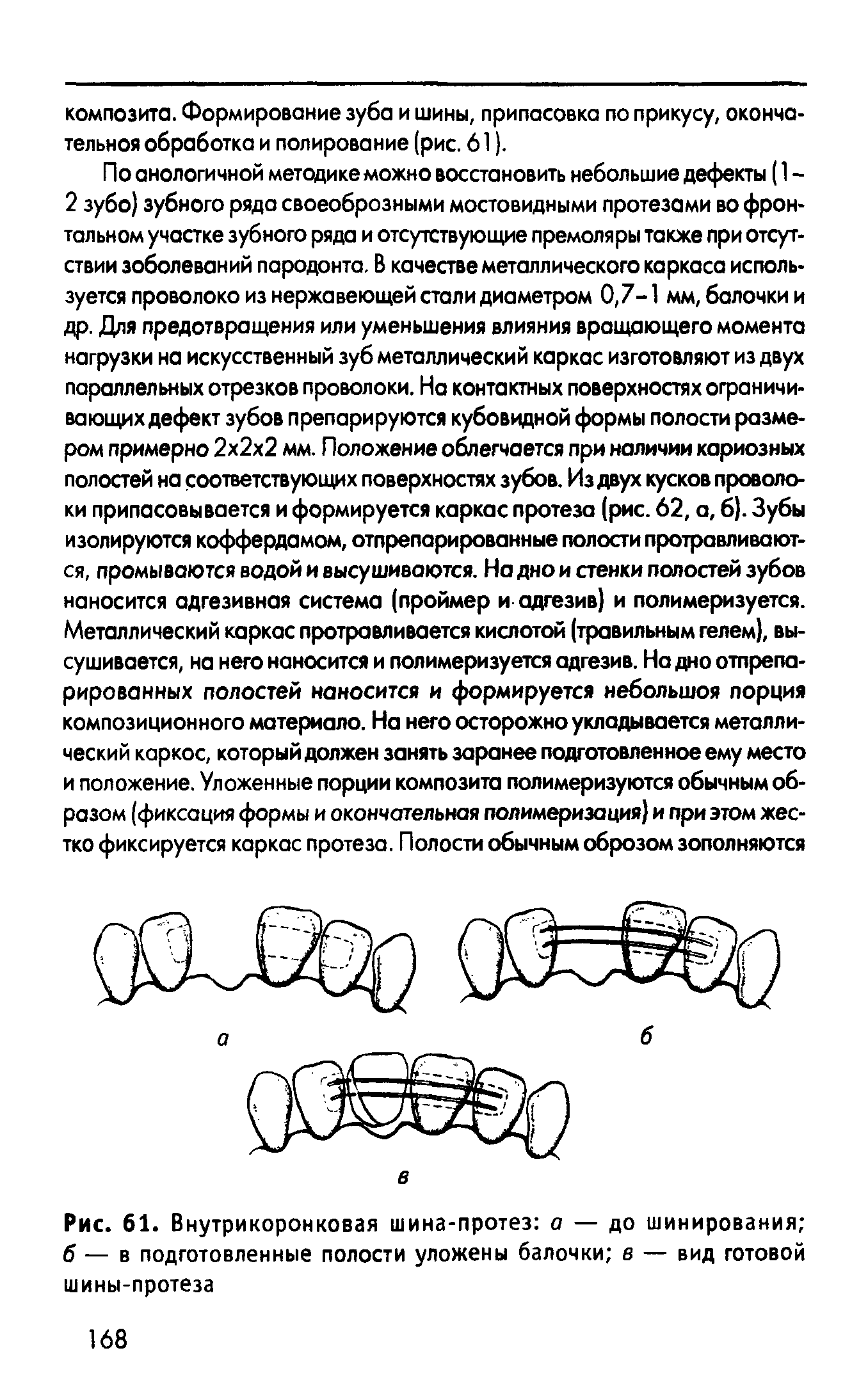 Рис. 61. Внутрикоронковая шина-протез а — до шинирования б — в подготовленные полости уложены балочки в — вид готовой шины-протеза...