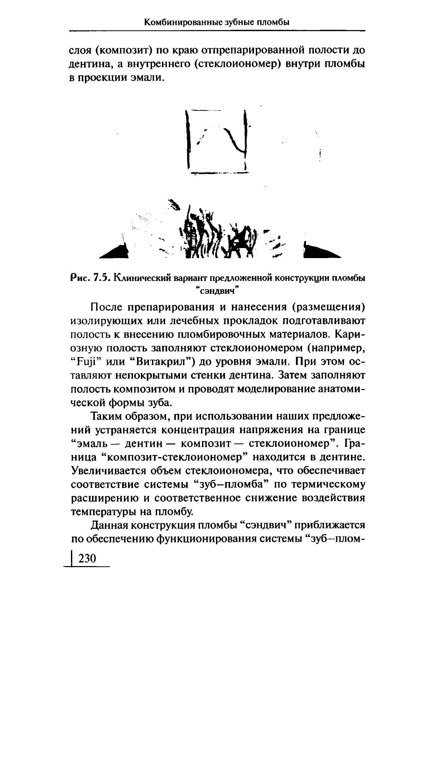 Рис. 7.5. Клинический вариант предложенной конструкции пломбы сэндвич ...