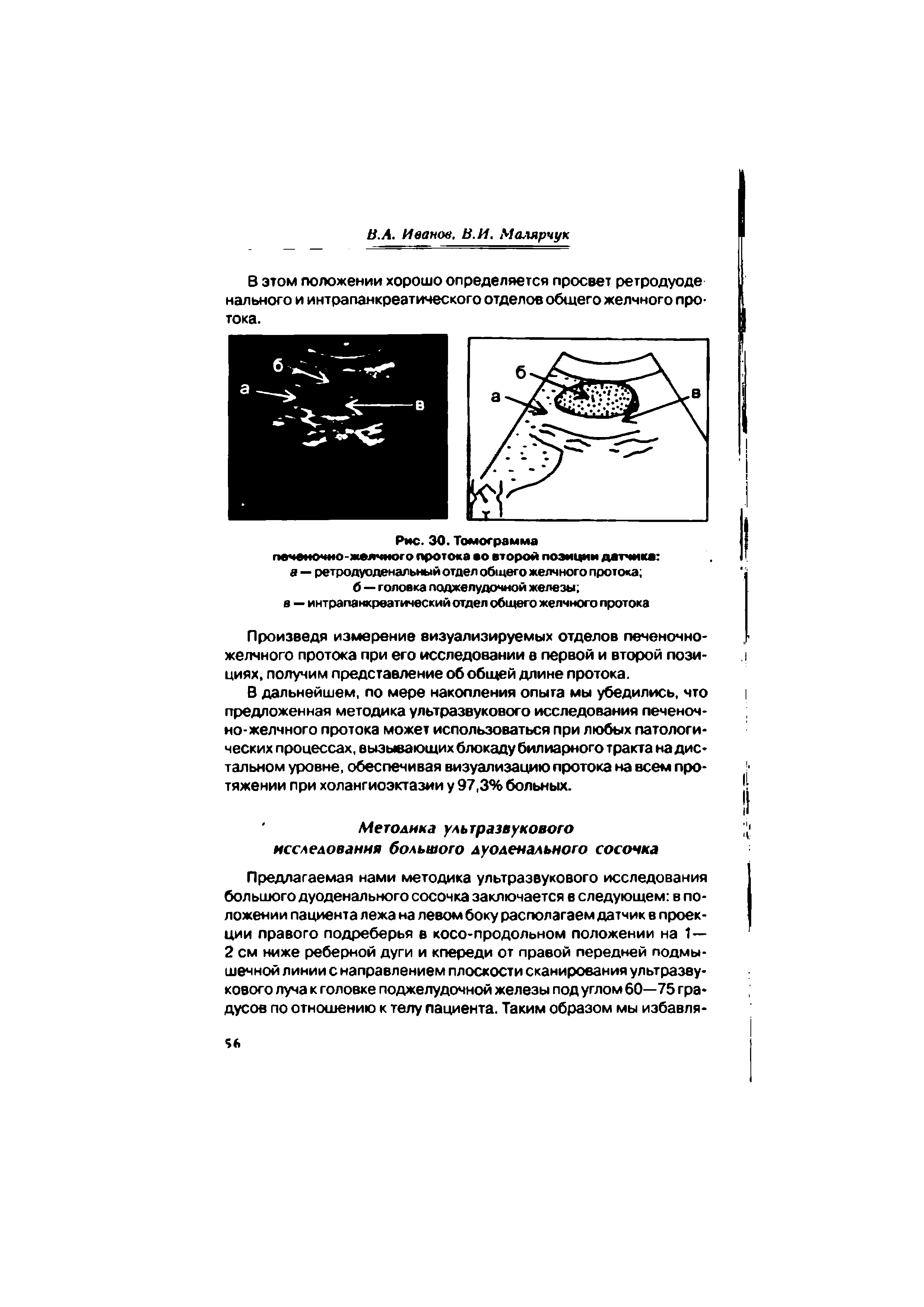 Рис. 30. Томограмма печеночно-желчного протока ао второй позиции датчика а — ретродуоденальный отдел общего желчного протока ...