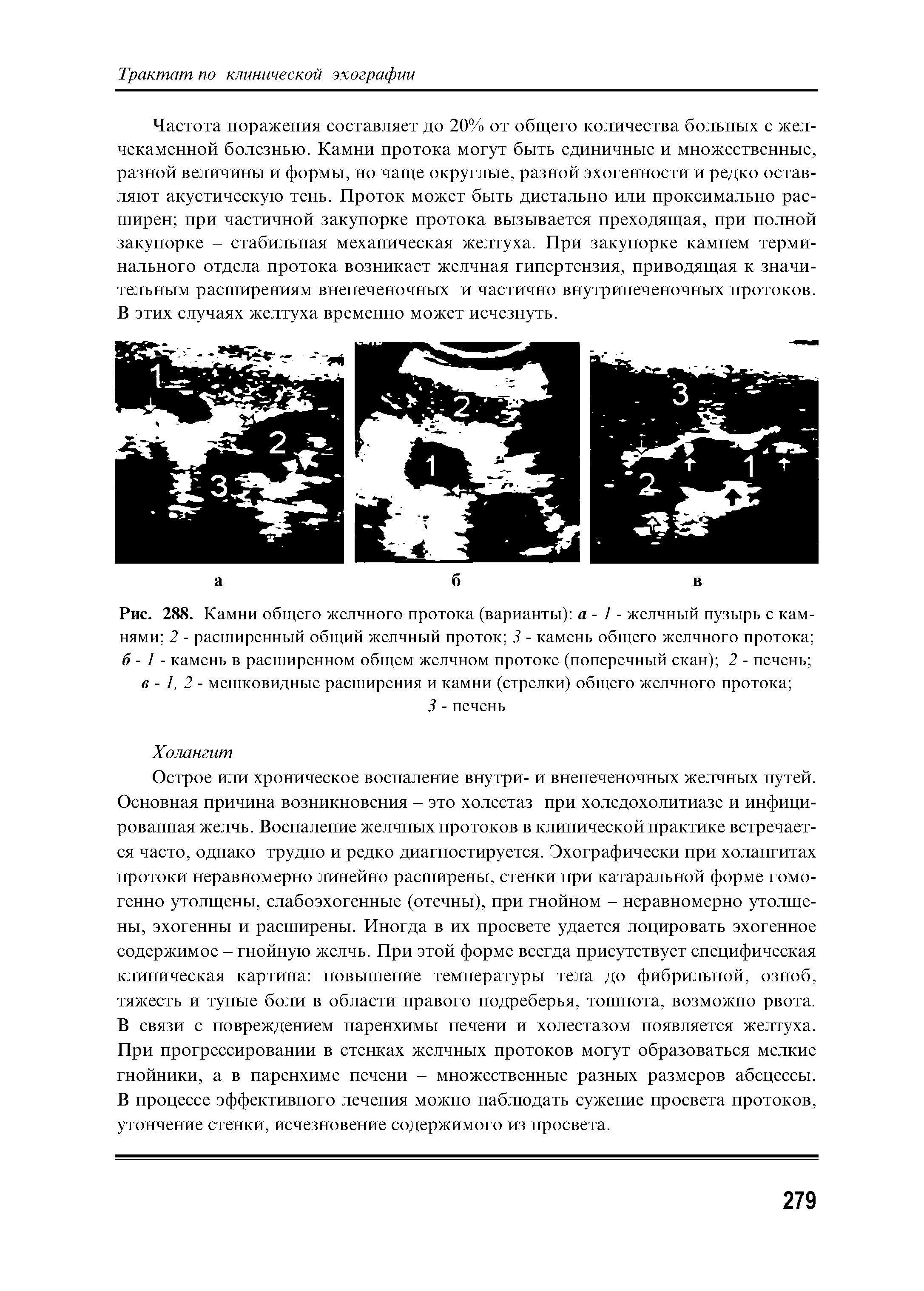 Рис. 288. Камни общего желчного протока (варианты) а - 1 - желчный пузырь с камнями 2 - расширенный общий желчный проток 3 - камень общего желчного протока б -1 - камень в расширенном общем желчном протоке (поперечный скан) 2 - печень ...