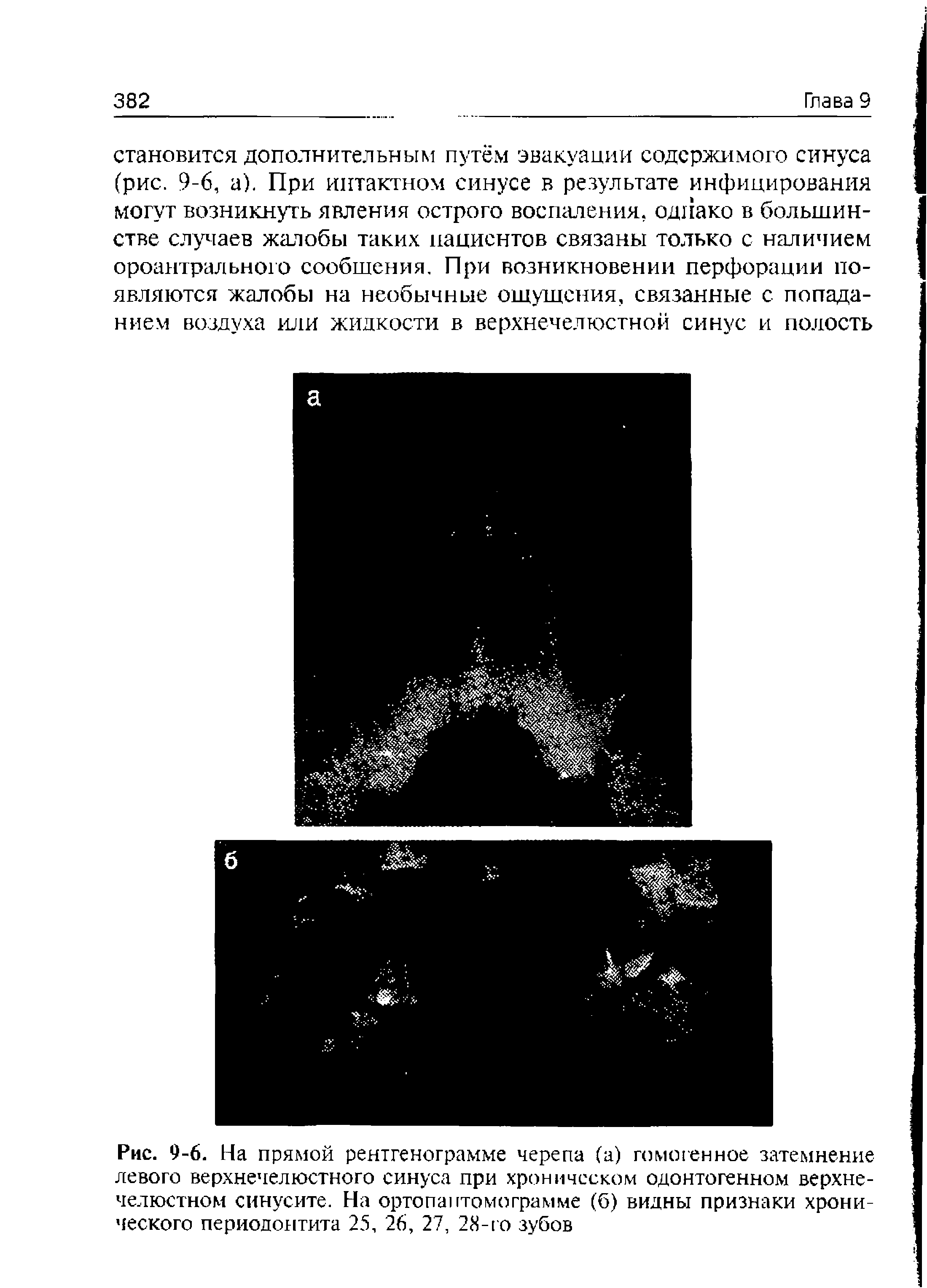 Рис. 9-6. На прямой рентгенограмме черепа (а) гомогенное затемнение левого верхнечелюстного синуса при хроническом одонтогенном верхнечелюстном синусите. На орто пактом о грамме (б) видны признаки хронического периодонтита 25, 26, 27, 28-го зубов...