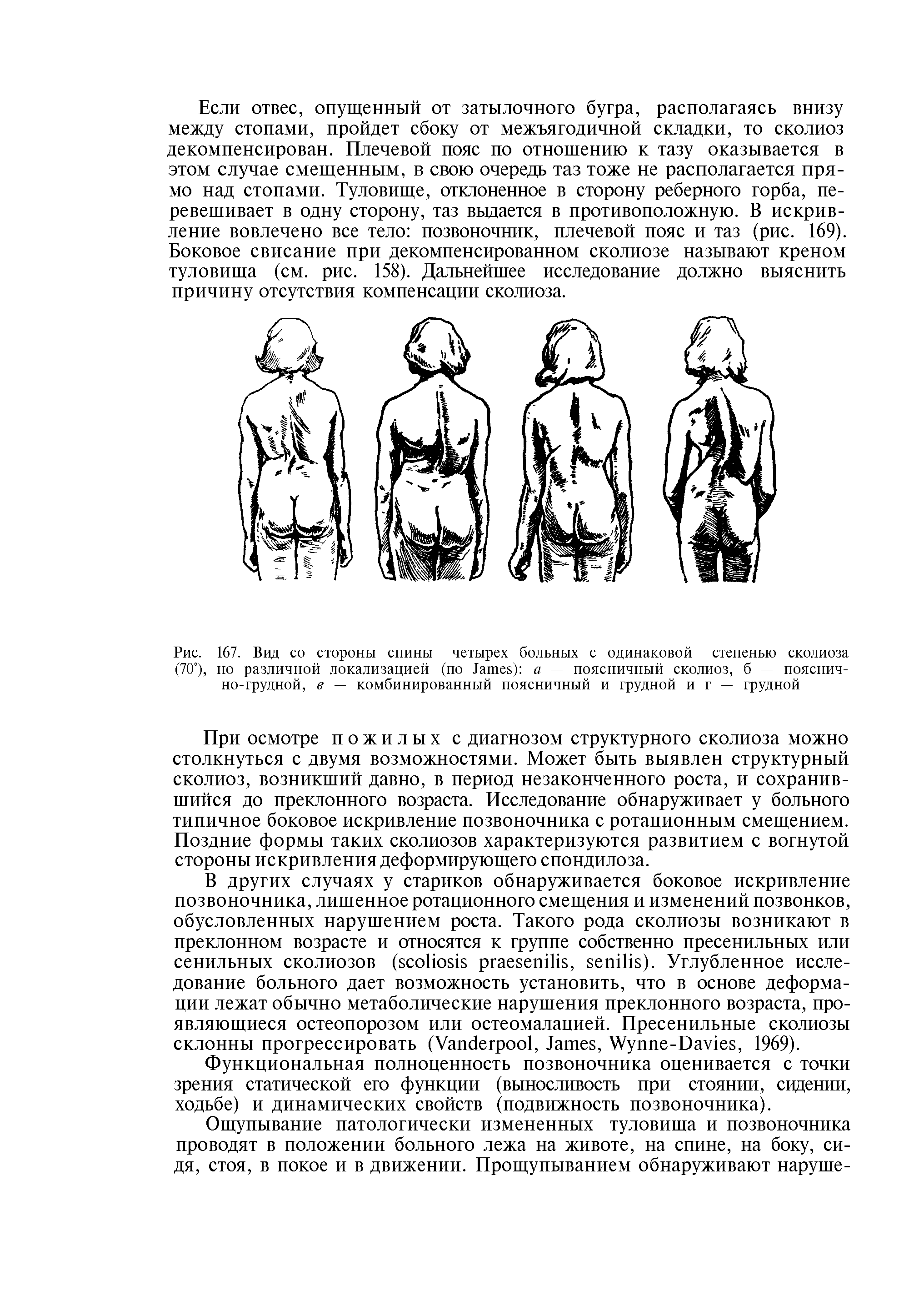 Рис. 167. Вид со стороны спины четырех больных с одинаковой степенью сколиоза (70°), но различной локализацией (по J ) а — поясничный сколиоз, б — пояснично-грудной, в — комбинированный поясничный и грудной и г — грудной...