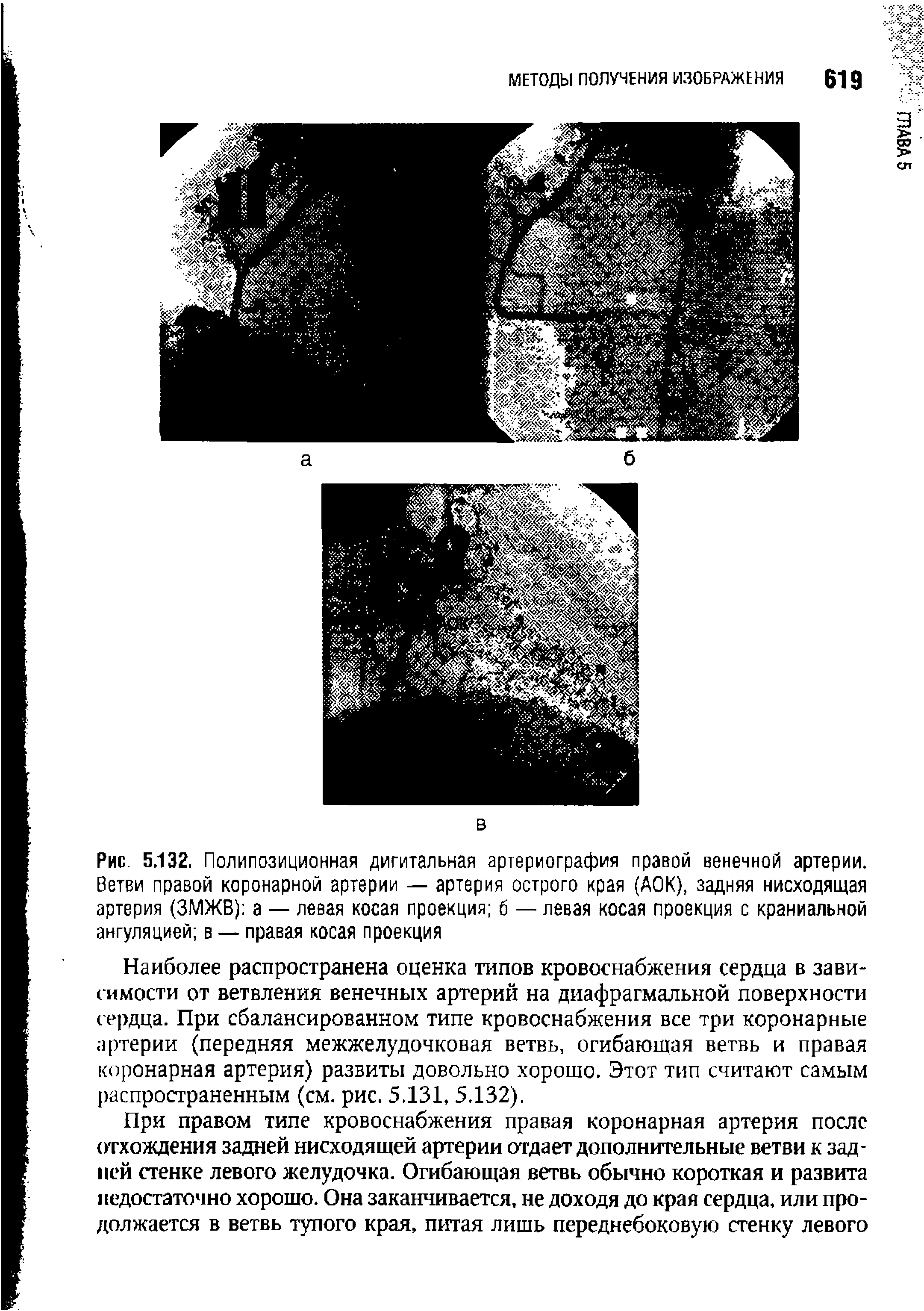 Рис. 5.132. Полипозиционная дигитальная артериография правой венечной артерии. Ветви правой коронарной артерии — артерия острого края (АОК), задняя нисходящая артерия (ЗМЖВ) а — левая косая проекция б — левая косая проекция с краниальной ангуляцией в — правая косая проекция...