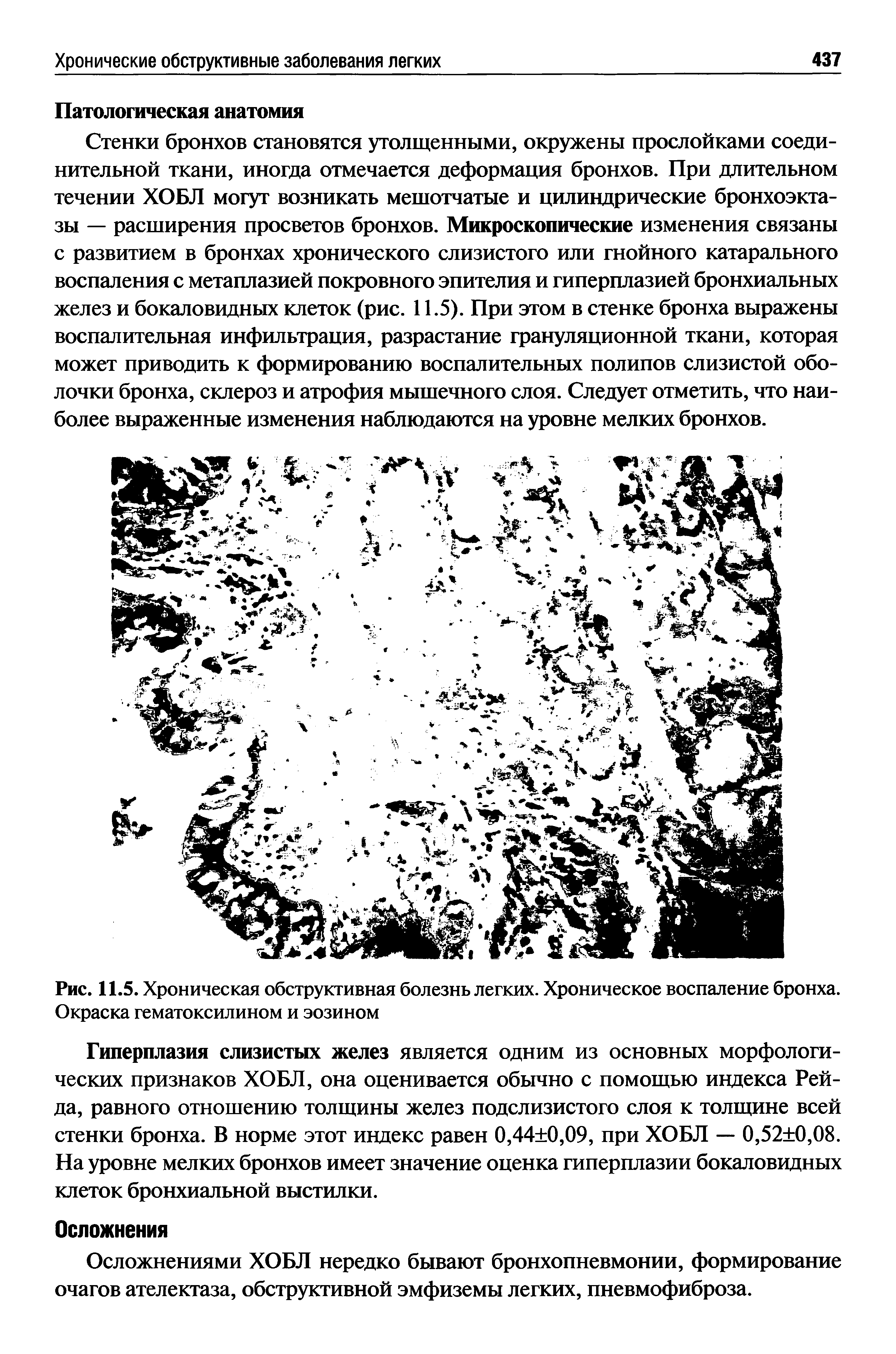 Рис. 11.5. Хроническая обструктивная болезнь легких. Хроническое воспаление бронха. Окраска гематоксилином и эозином...