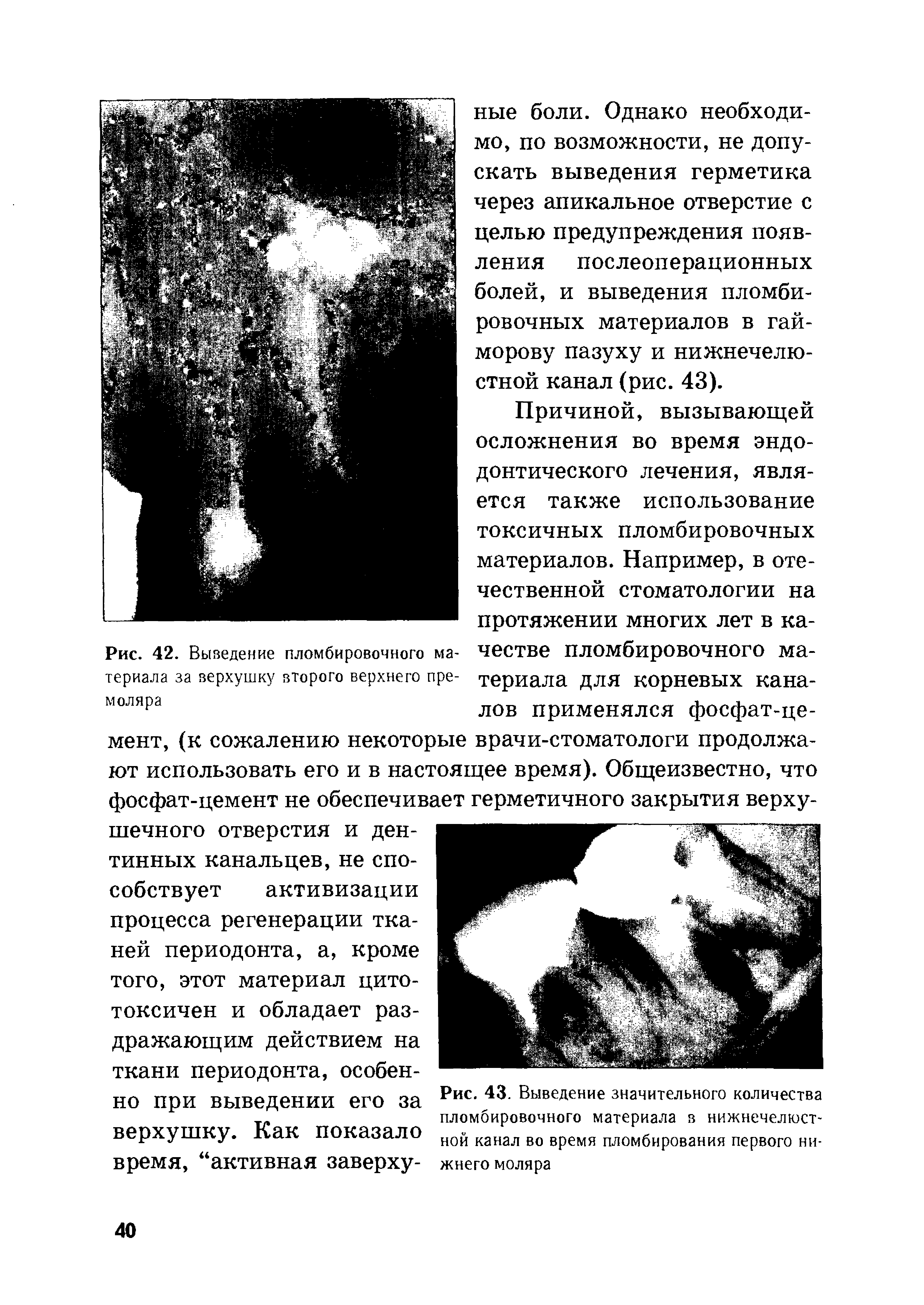 Рис. 43. Выведение значительного количества пломбировочного материала в нижнечелюстной канал во время пломбирования первого нижнего моляра...