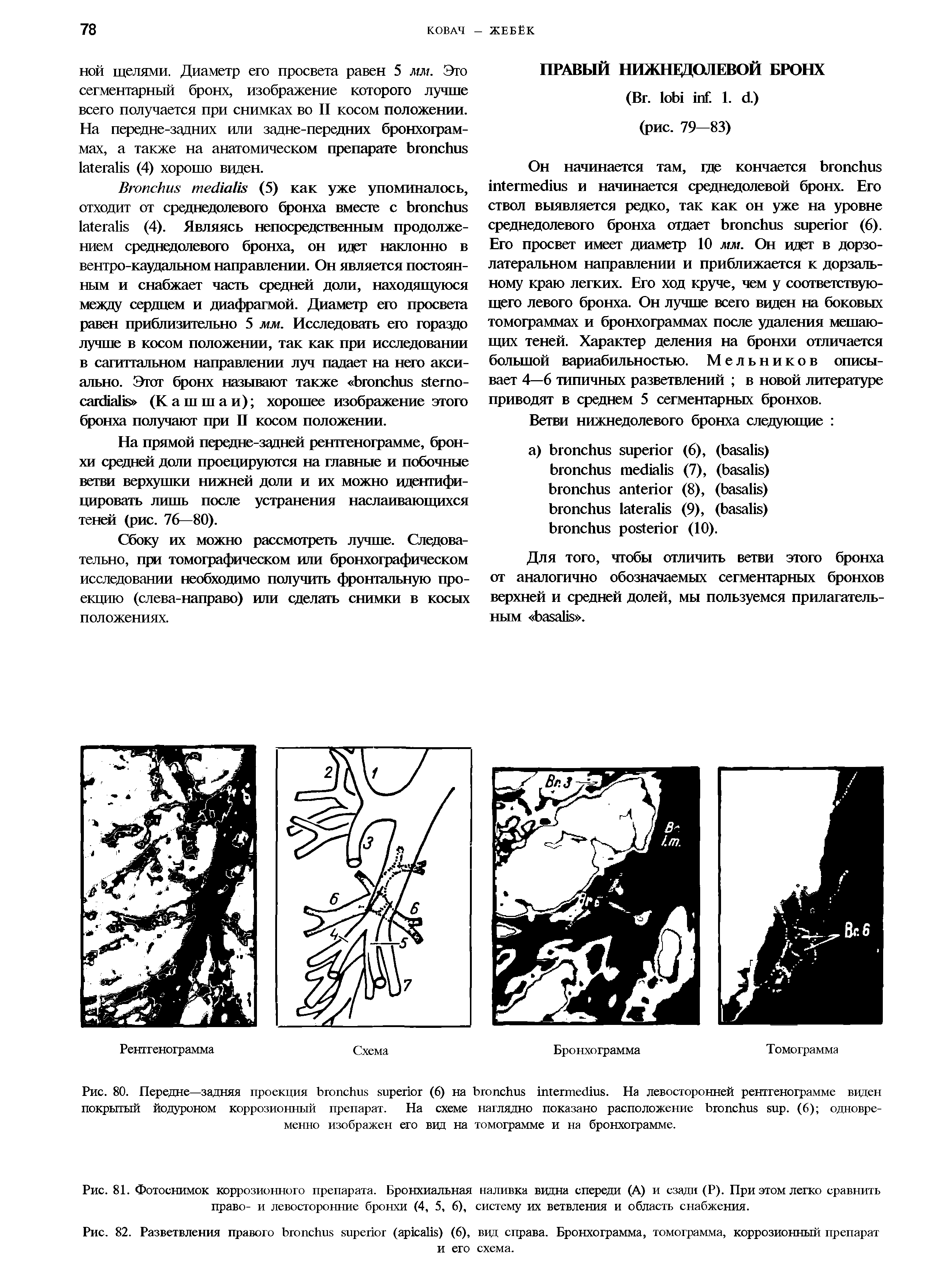 Рис. 80. Передне—задняя проекция (6) на . На левосторонней рентгенограмме виден покрытый йодуроном коррозионный препарат. На схеме наглядно показано расположение . (6) одновременно изображен его вид на томограмме и на бронхограмме.