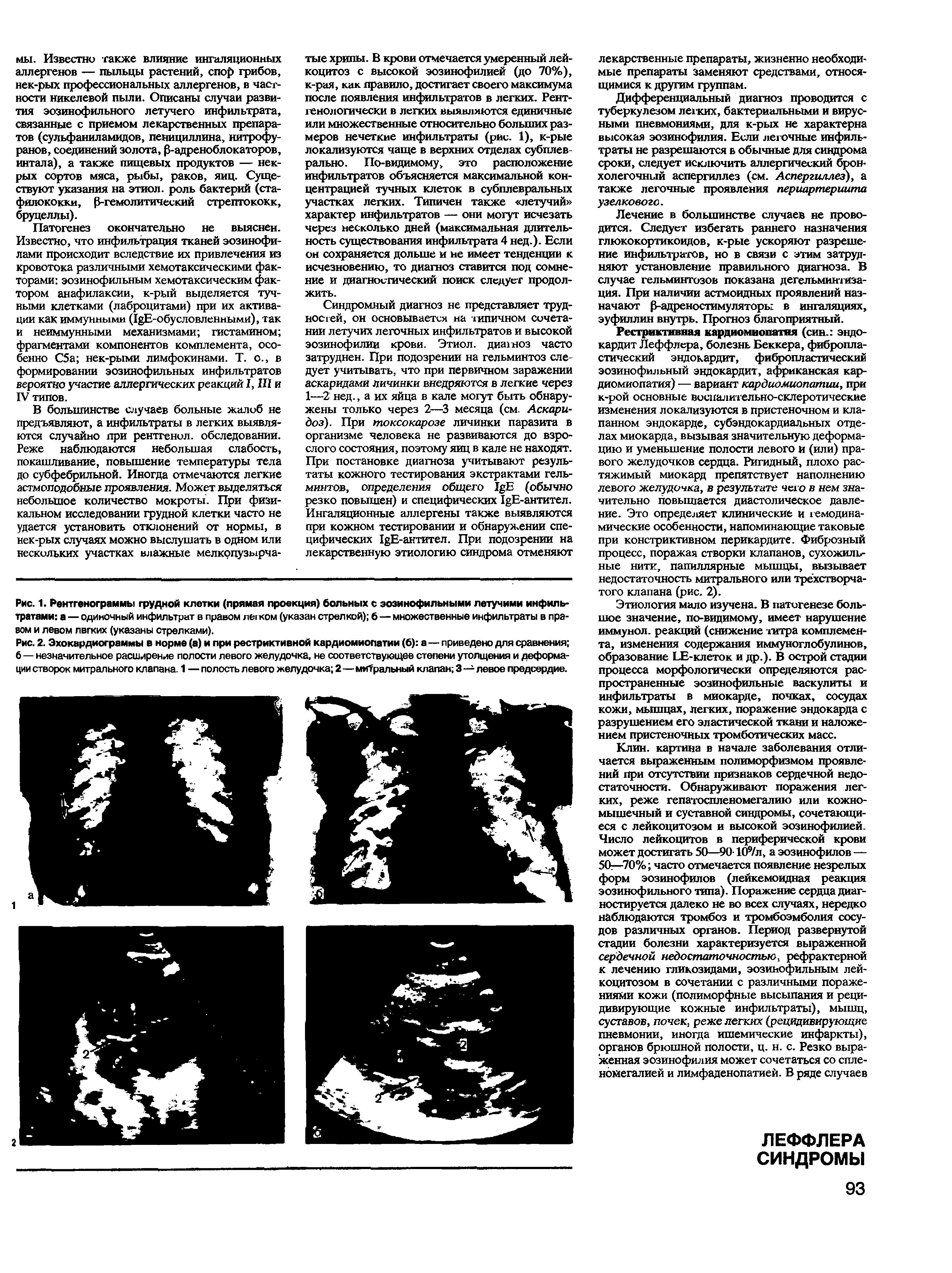 Рис. 1. Рентгенограммы грудной клетки (прямая проекция) больных с эозинофильными летучими инфильтратами а — одиночный инфильтрат в правом лыком (указан стрелкой) б — множественные инфильтраты в правом и левом лвгких (указаны стрелками).