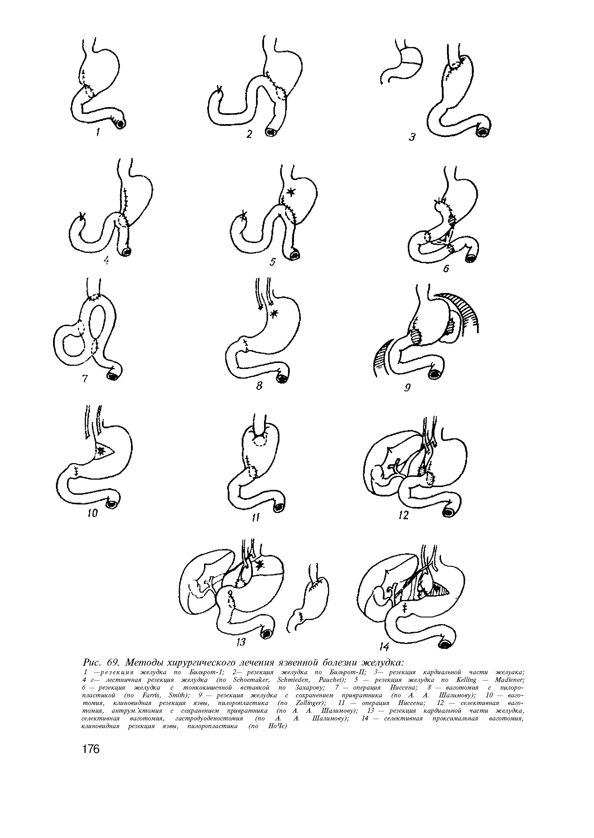 Рис. 69. Методы хирургического лечения язвенной болезни желудка ...