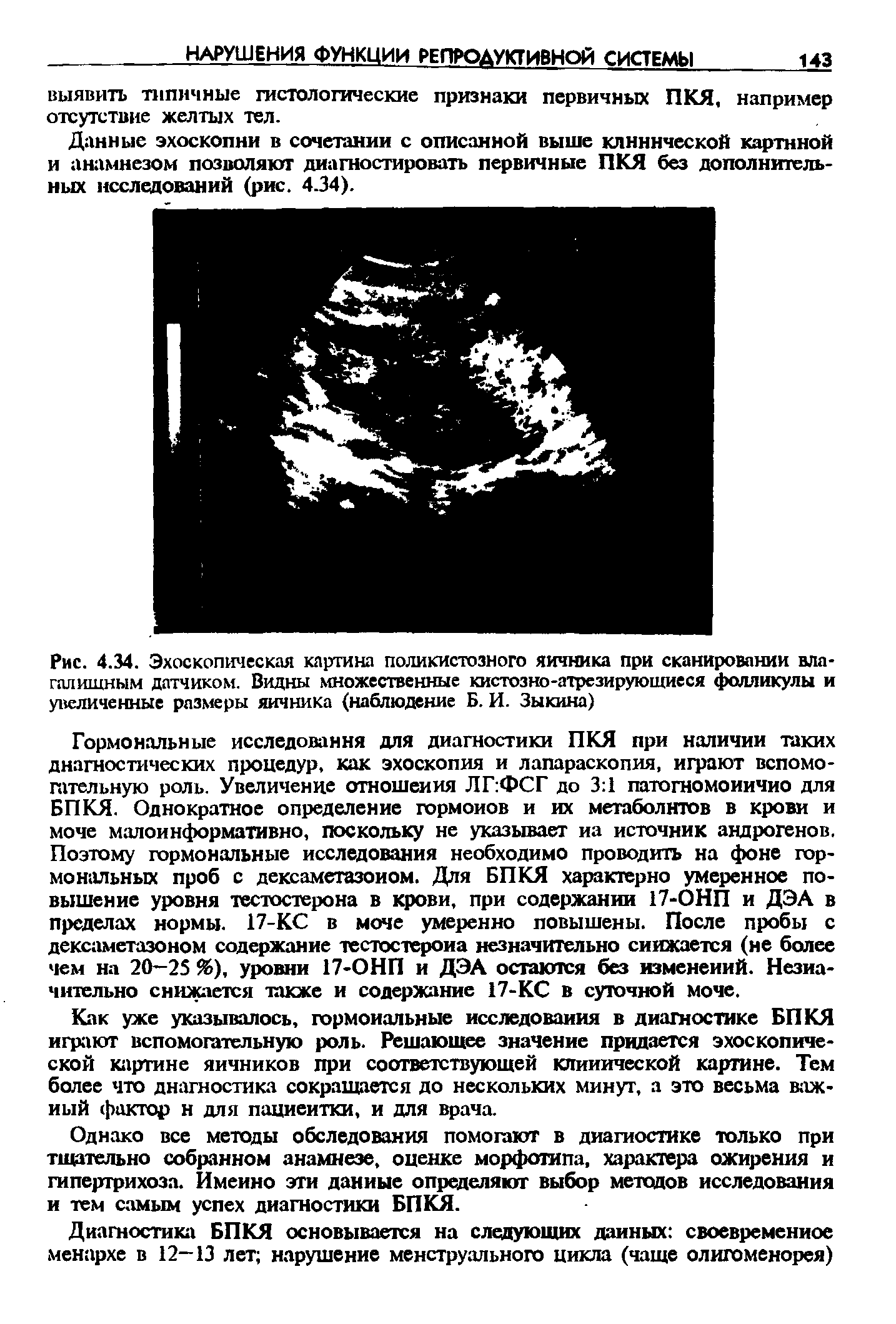 Рис. 4.34. Эхоскопическая картина поликистозного яичника при сканировании влагалищным датчиком. Видны множественные кистозно-атрезирующиеся фолликулы и увеличенные размеры яичника (наблюдение Б. И. Зыкина)...