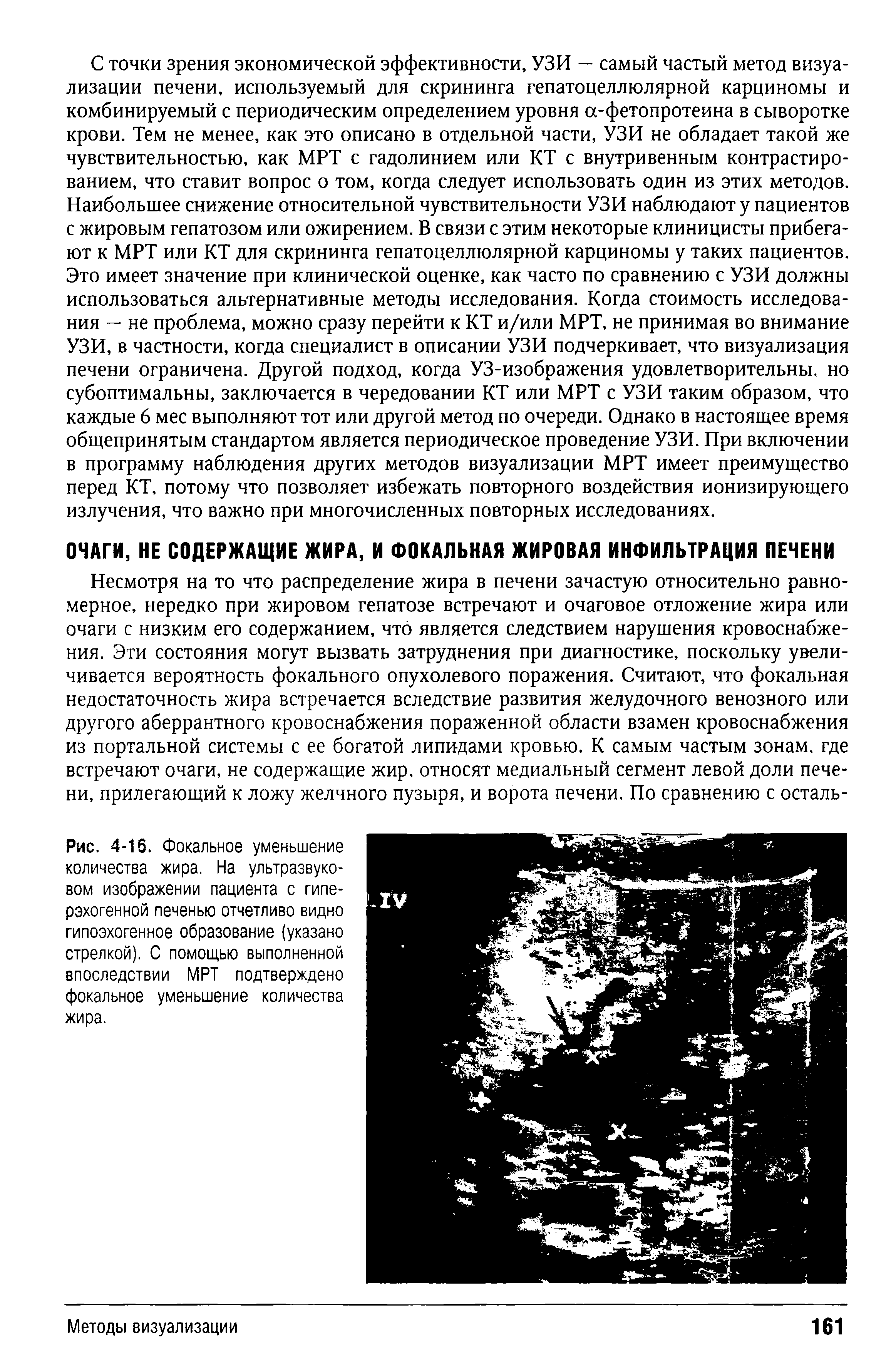 Рис. 4-16. Фокальное уменьшение количества жира. На ультразвуковом изображении пациента с гиперэхогенной печенью отчетливо видно гипоэхогенное образование (указано стрелкой). С помощью выполненной впоследствии МРТ подтверждено фокальное уменьшение количества жира.