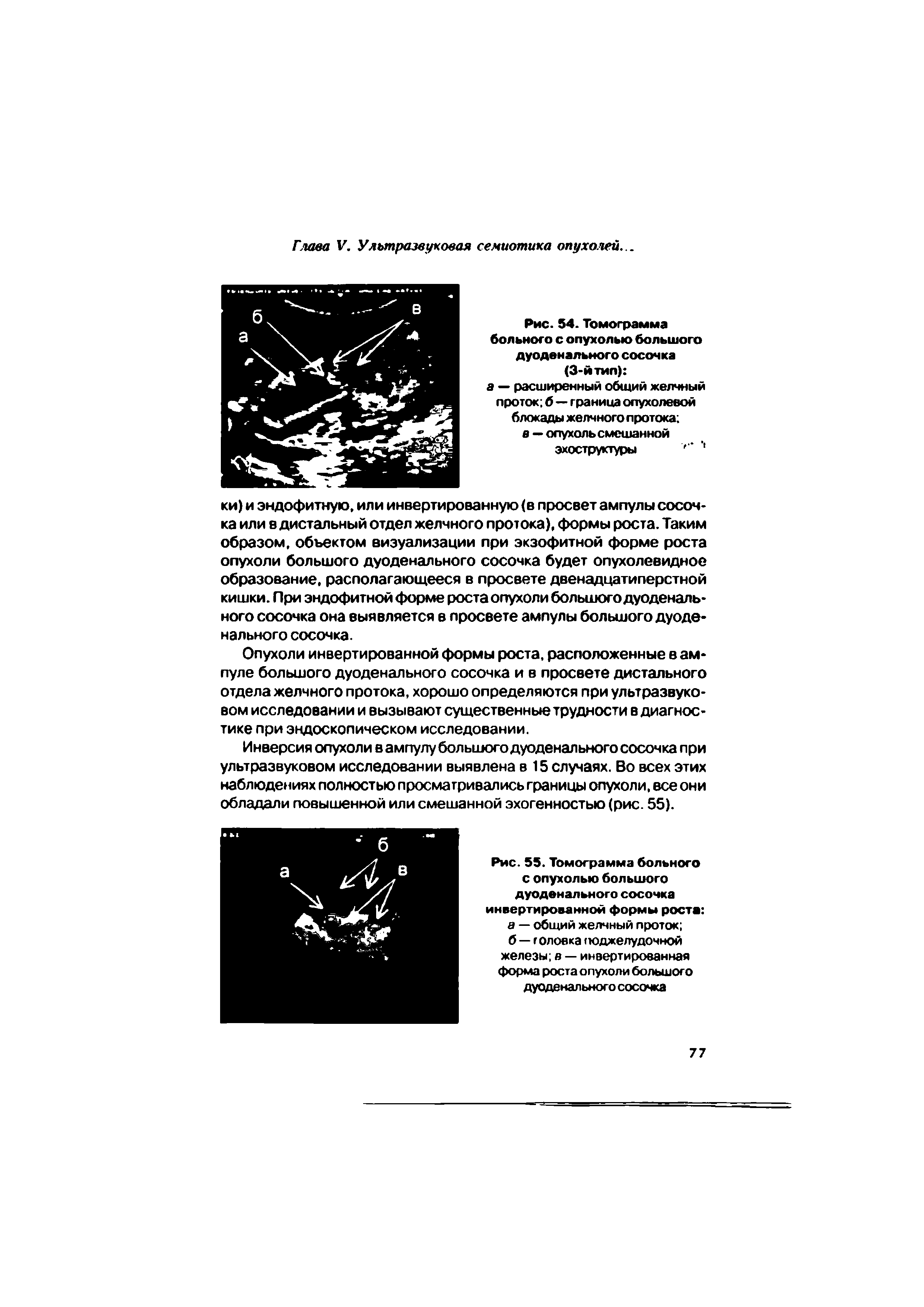 Рис. 54. Томограмма больного с опухолью большого дуоденального сосочка (3-йтил) а — расширенный общий желчный проток б — граница опухолевой блокады желчного протока в — опухоль смешанной эхоструктуры ...