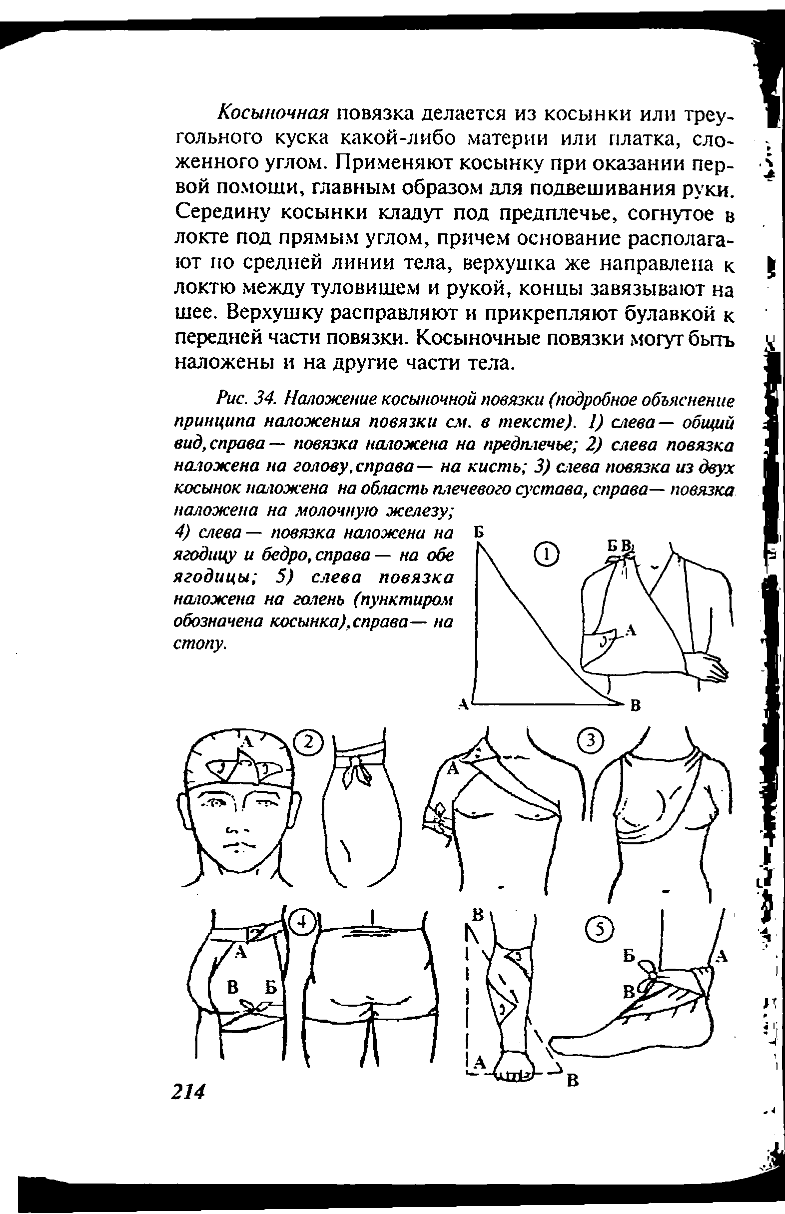 Рис. 34. Наложение косыночной повязки (подробное объяснение принципа наложения повязки см. в тексте). 1) слева— общий вид, справа — повязка наложена на предплечье 2) слева повязка наложена на голову,справа— на кисть 3) слева повязка из двух косынок наложена на область плечевого сустава, справа— повязка...