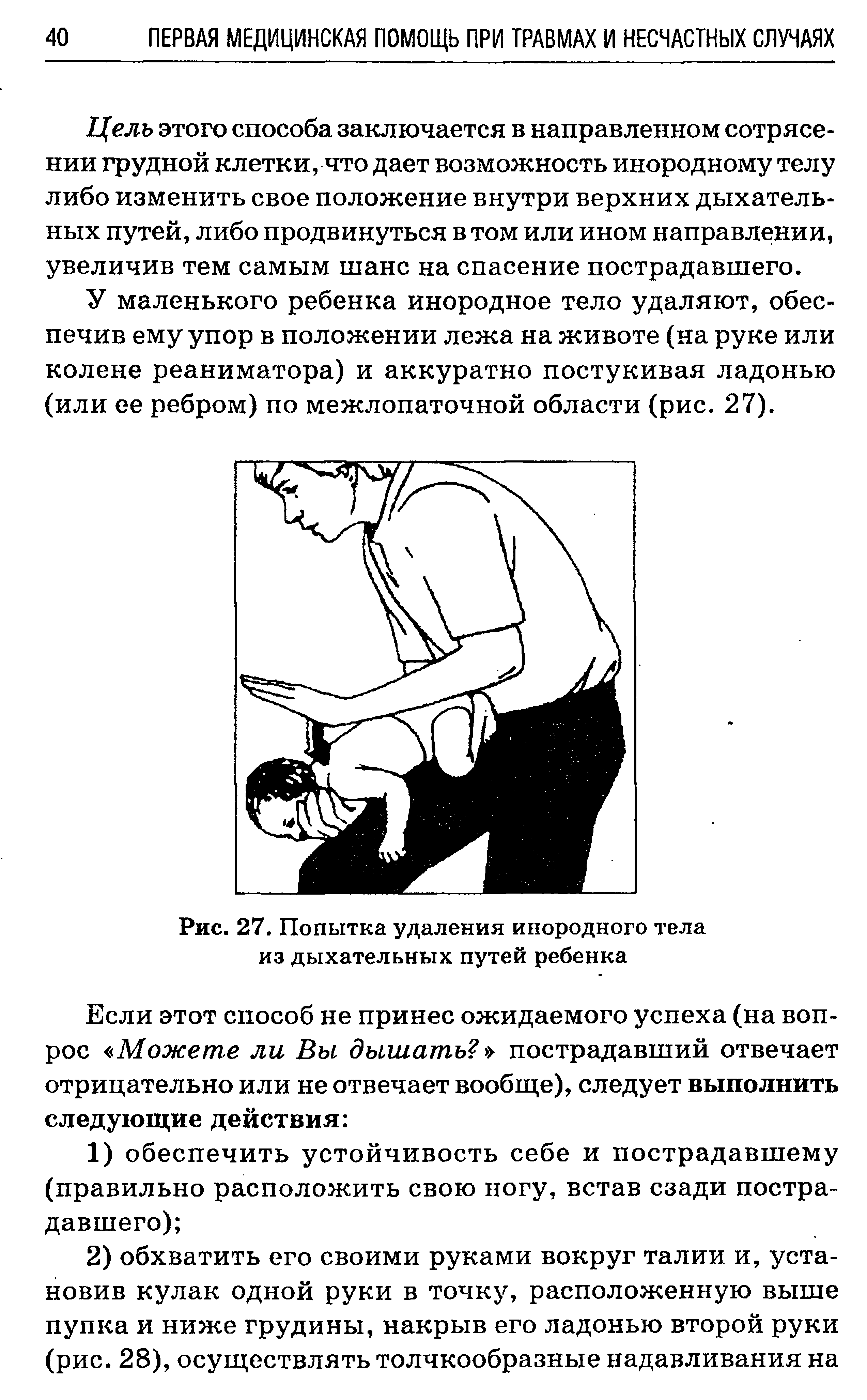 Рис. 27. Попытка удаления инородного тела из дыхательных путей ребенка...