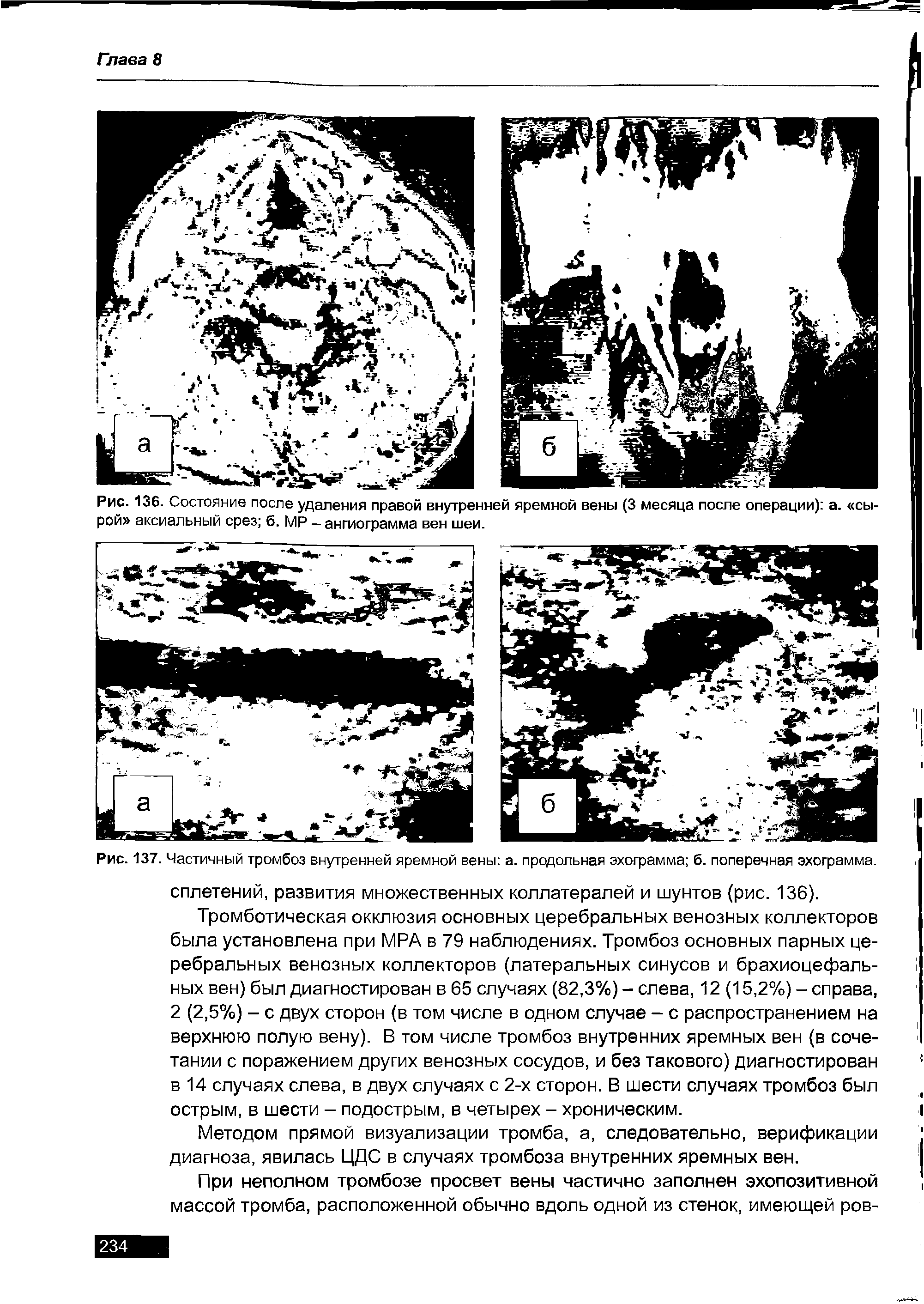 Рис. 137. Частичный тромбоз внутренней яремной вены а. продольная эхограмма б. поперечная эхограмма.