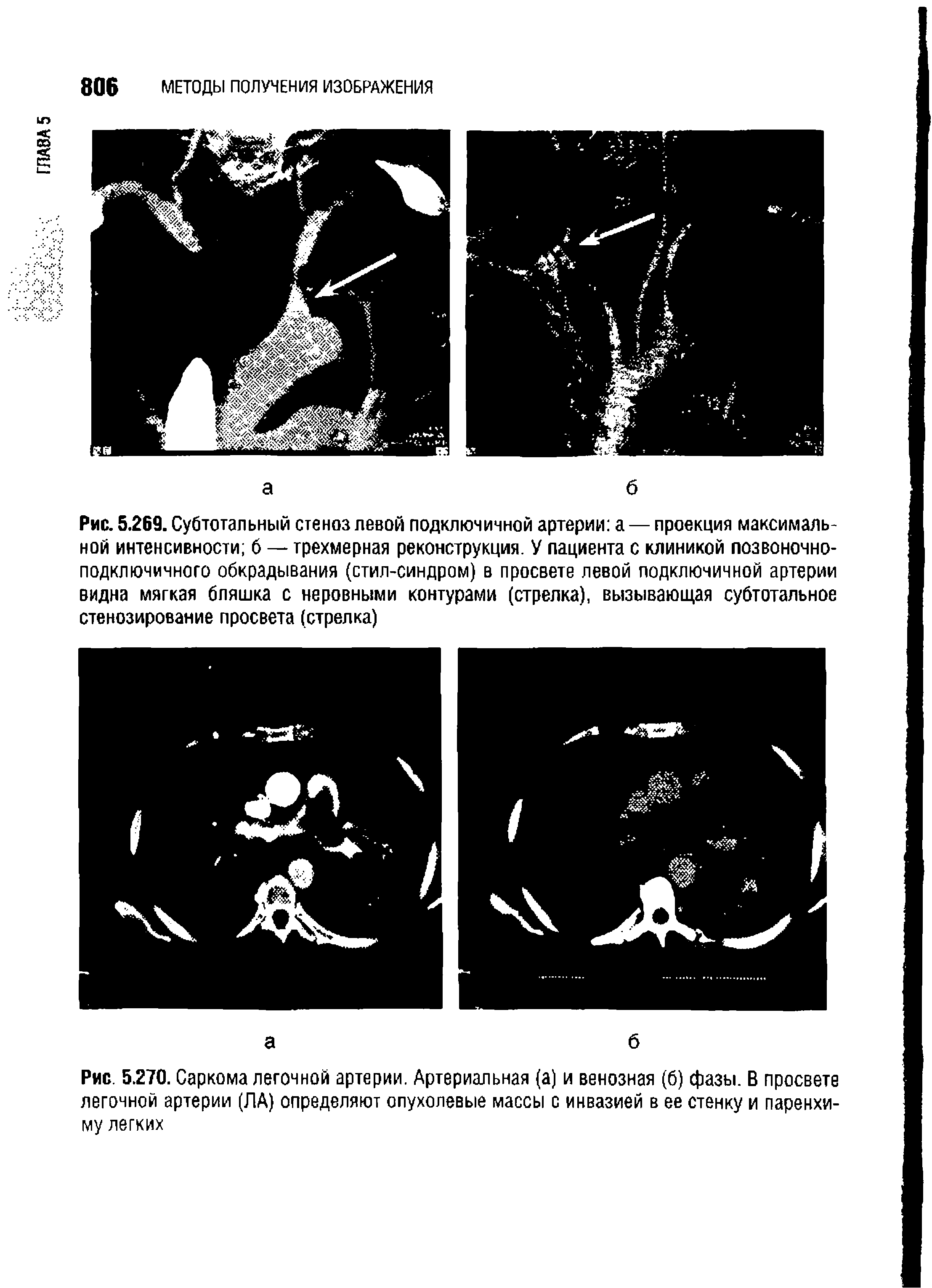 Рис. 5.269. Субтотальный стеноз левой подключичной артерии а — проекция максимальной интенсивности 6 — трехмерная реконструкция. У пациента с клиникой позвоночноподключичного обкрадывания (стил-синдром) в просвете левой подключичной артерии видна мягкая бляшка с неровными контурами (стрелка), вызывающая субтотальное стенозирование просвета (стрелка)...