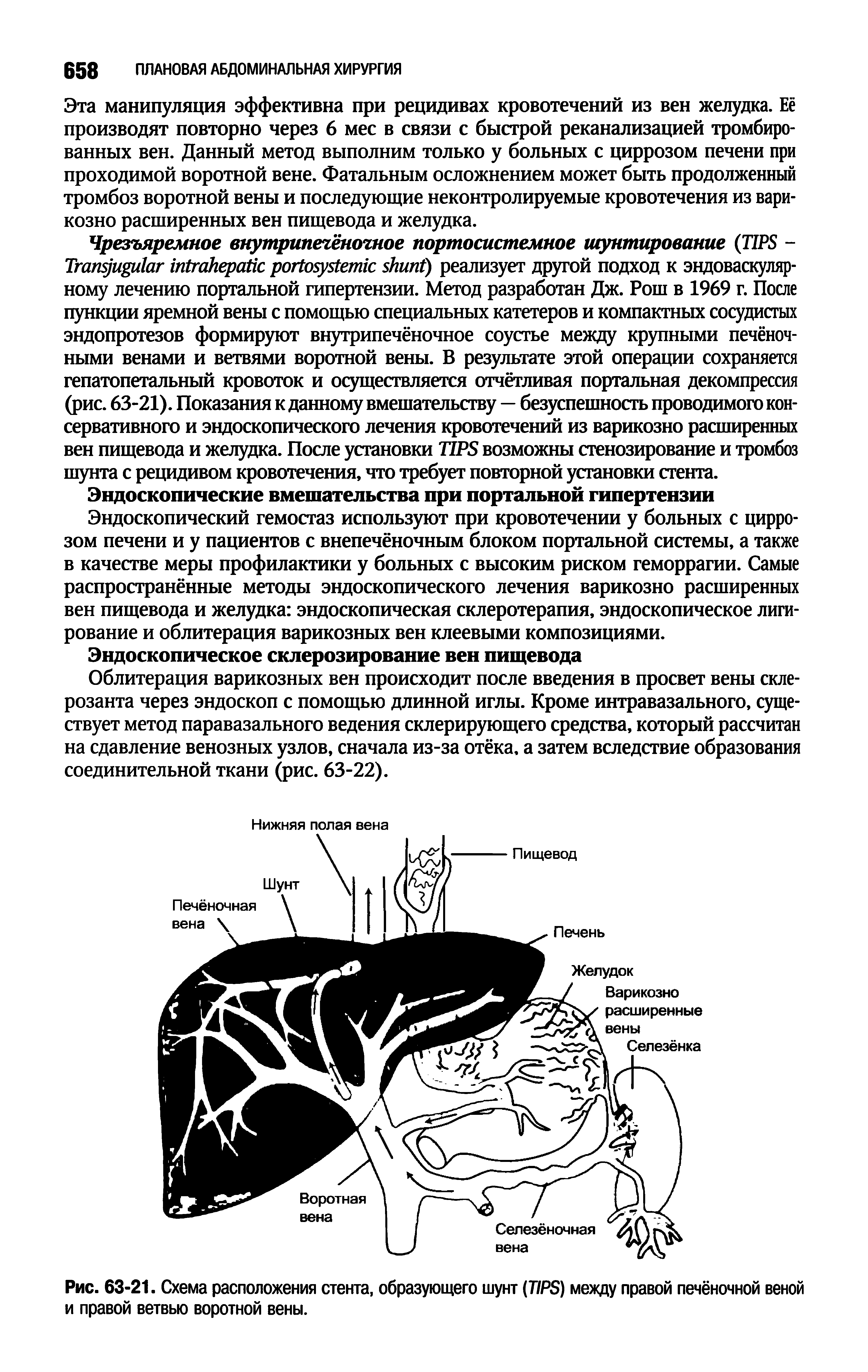 Рис. 63-21. Схема расположения стента, образующего шунт (TIPS) между правой печёночной веной и правой ветвью воротной вены.