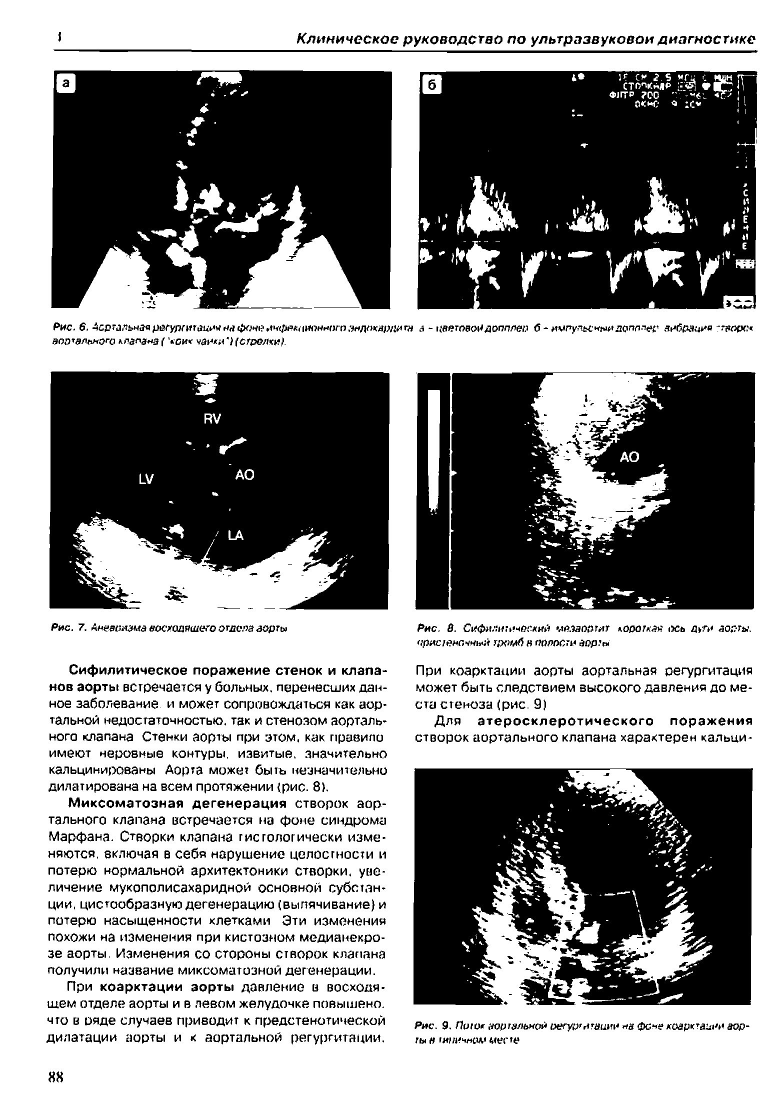 Рис. 8. Сифилитический ы к эоргиг короткая 1)Сь дуги аорты, пристеночный тромб в полости аорты...