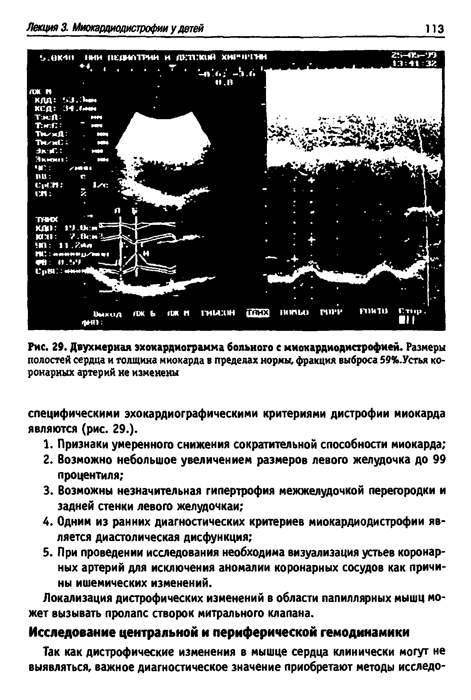 Рис. 29. Двухмерная эхокардиограмма больного с миокардиодистрофией. Размеры полостей сердца и толщина миокарда в пределах нормы, фракция выброса 59%.Устья коронарных артерий не изменены...