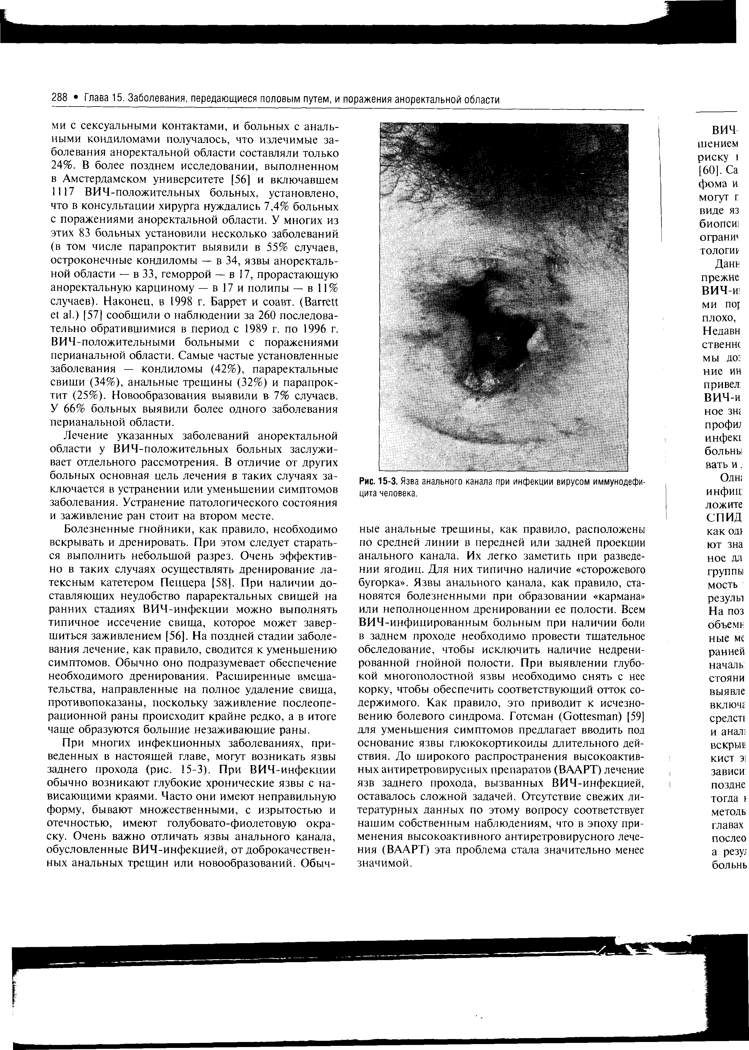 Рис. 15-3. Язва анального канала при инфекции вирусом иммунодефицита человека.