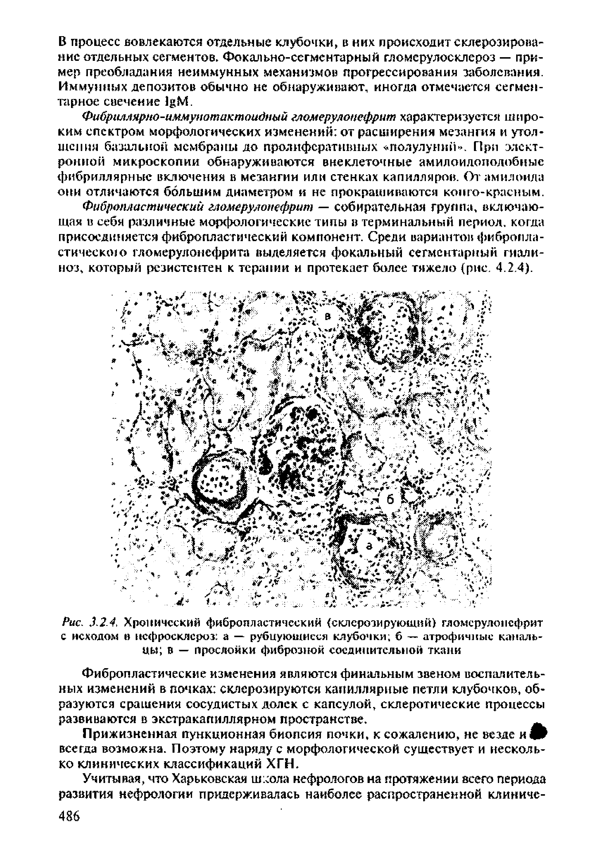 Рис. 3.2.4, Хронический фибробластический (склерозирующий гломерулонефрит с исходом в нсфросклсроз а — рубцующиеся клубочки б — атрофичные канальцы В — прослойки фиброзной соединительной ткани...