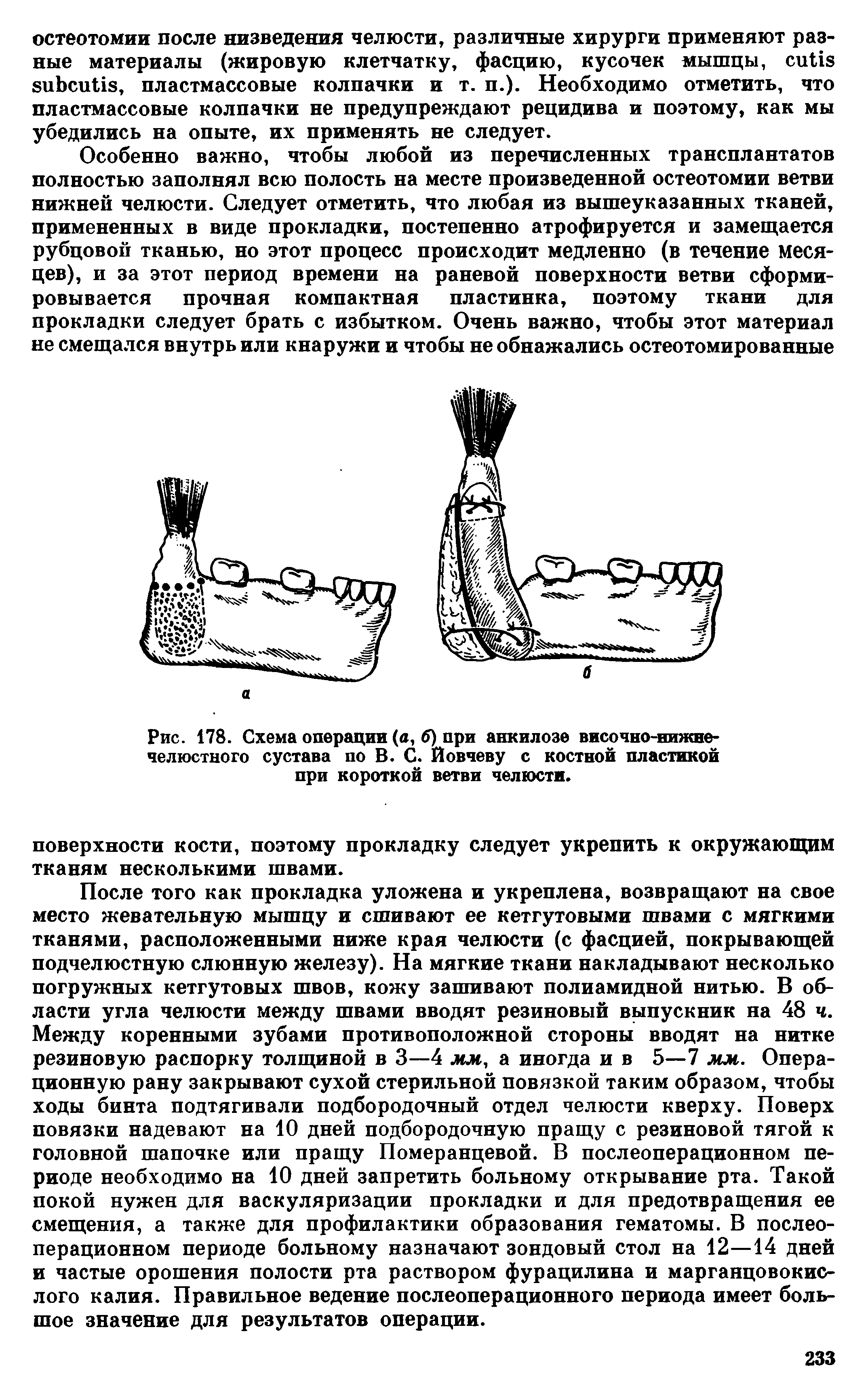 Рис. 178. Схема операции (а, б) при анкилозе височно-нижнечелюстного сустава по В. С. Йовчеву с костной пластикой при короткой ветви челюсти.