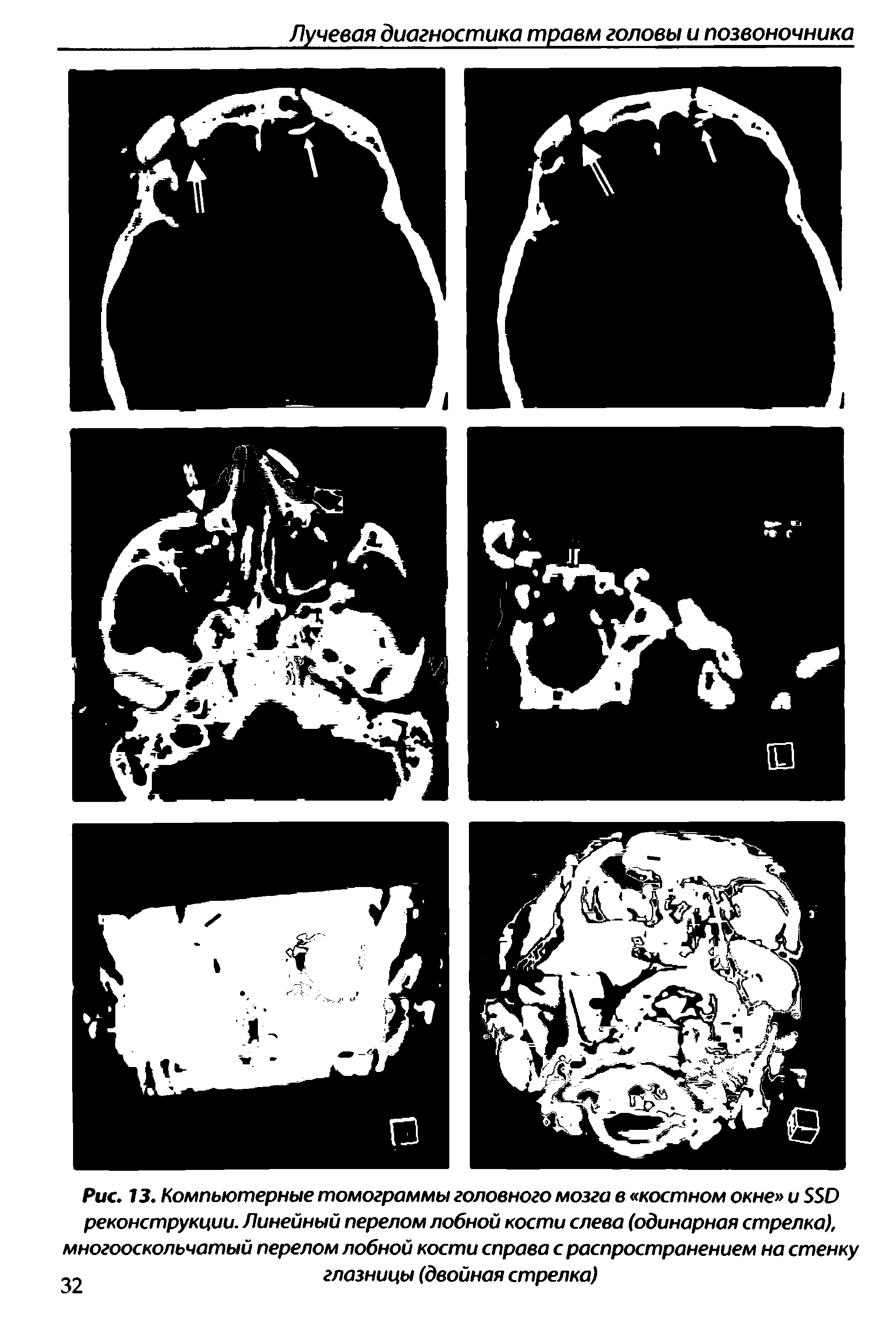 Рис. 13. Компьютерные томограммы головного мозга в костном окне и ББО реконструкции. Линейный перелом лобной кости слева (одинарная стрелка), многооскольчатый перелом лобной кости справа с распространением на стенку глазницы (двойная стрелка)...
