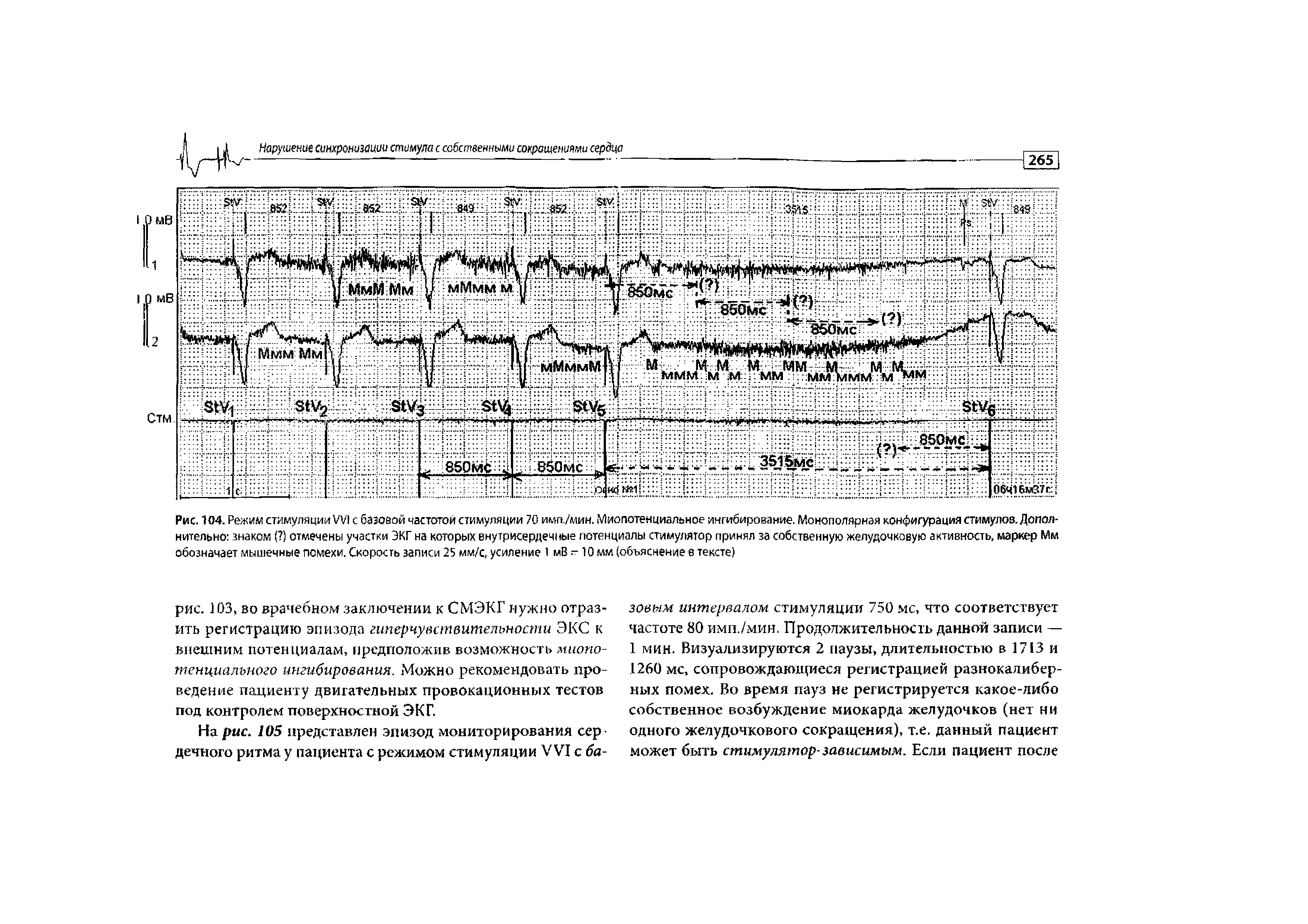 Рис. 104. Режим стимуляции М1 с базовой частотой стимуляции 70 имп./мин. Миопотенциальное ингибирование. Монополярная конфигурация стимулов. Дополнительно знаком ( ) отмечены участки ЭКГ на которых внутрисердечные потенциалы стимулятор принял за собственную желудочковую активность, маркер Мм обозначает мышечные помехи. Скорость записи 25 мм/с, усиление 1 мВ -10 мм (объяснение в тексте)...