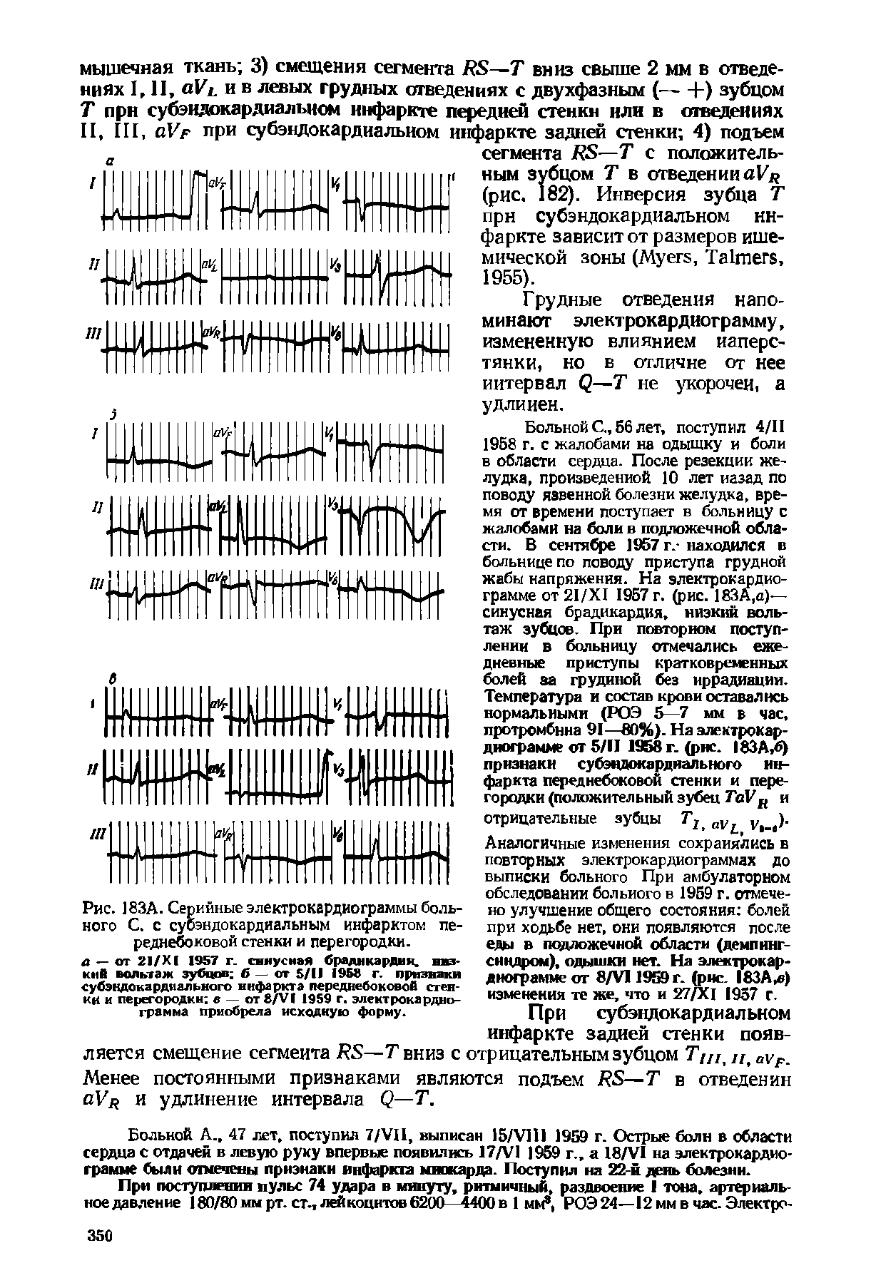 Рис. 183А. Серийные электрокардиограммы больного С. с субэндокардиальным инфарктом переднебоковой стенки и перегородки.