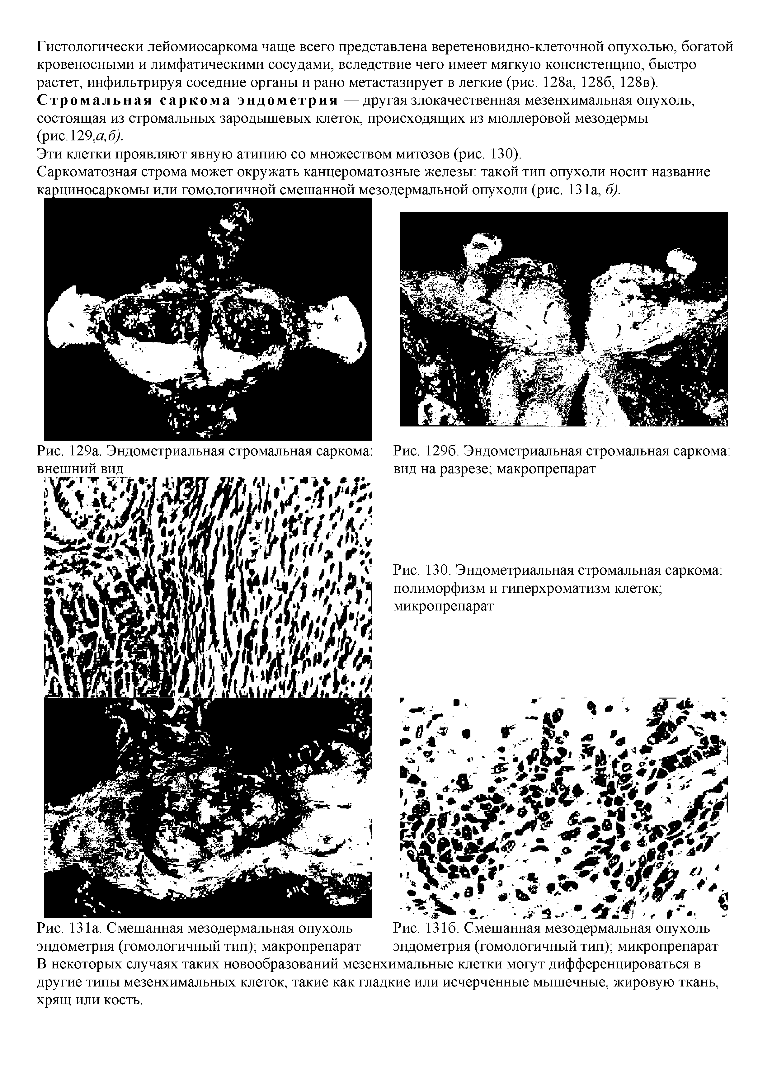 Рис. 129а. Эндометриальная стромальная саркома Рис. 1296. Эндометриальная стромальная саркома ...