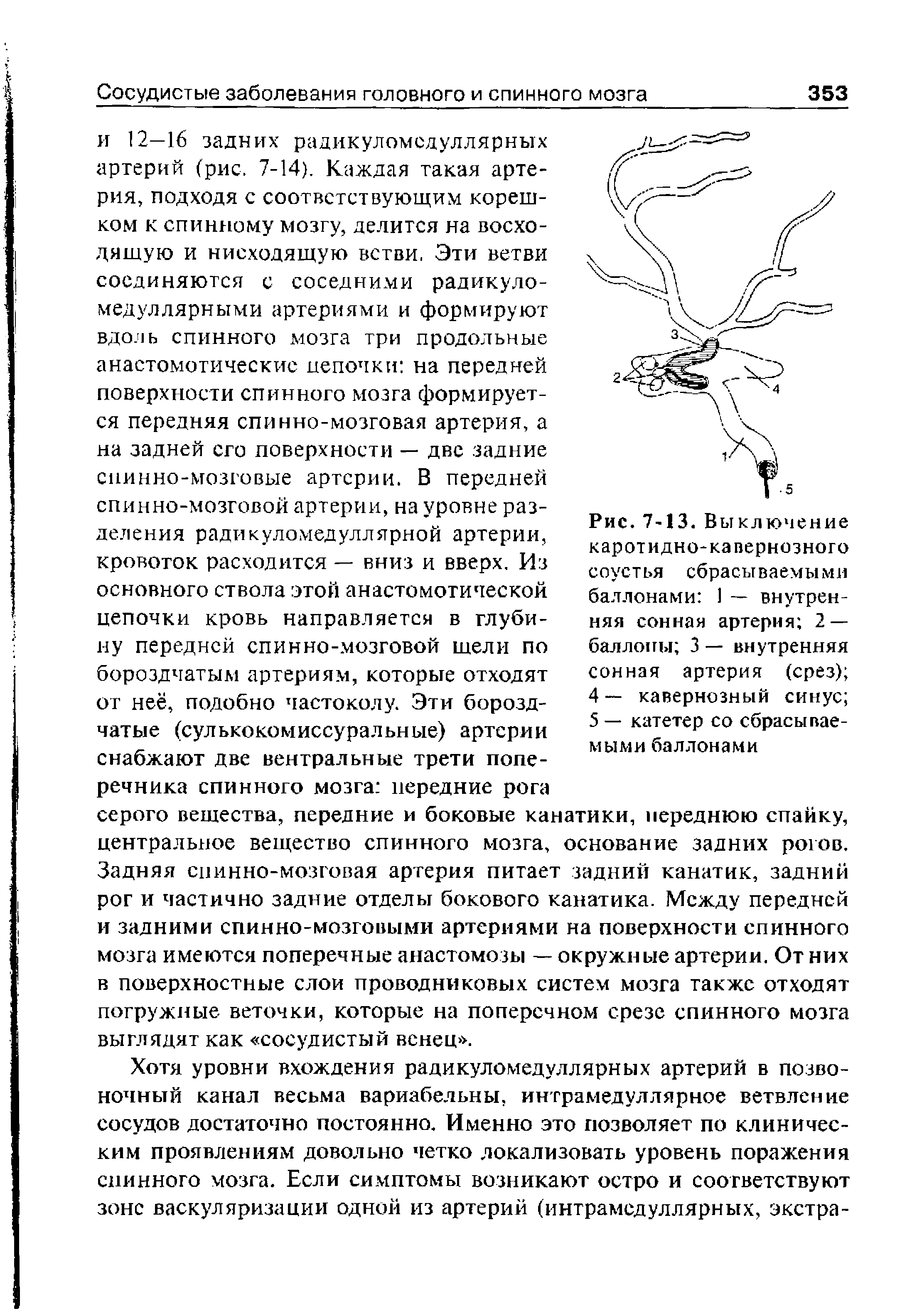 Рис. 7-13. В ы кл течение каротидно-кавернозного соустья сбрасываемыми баллонами 1 — внутренняя сонная артерия 2 — баллоны 3 — внутренняя сонная артерия (срез) ...