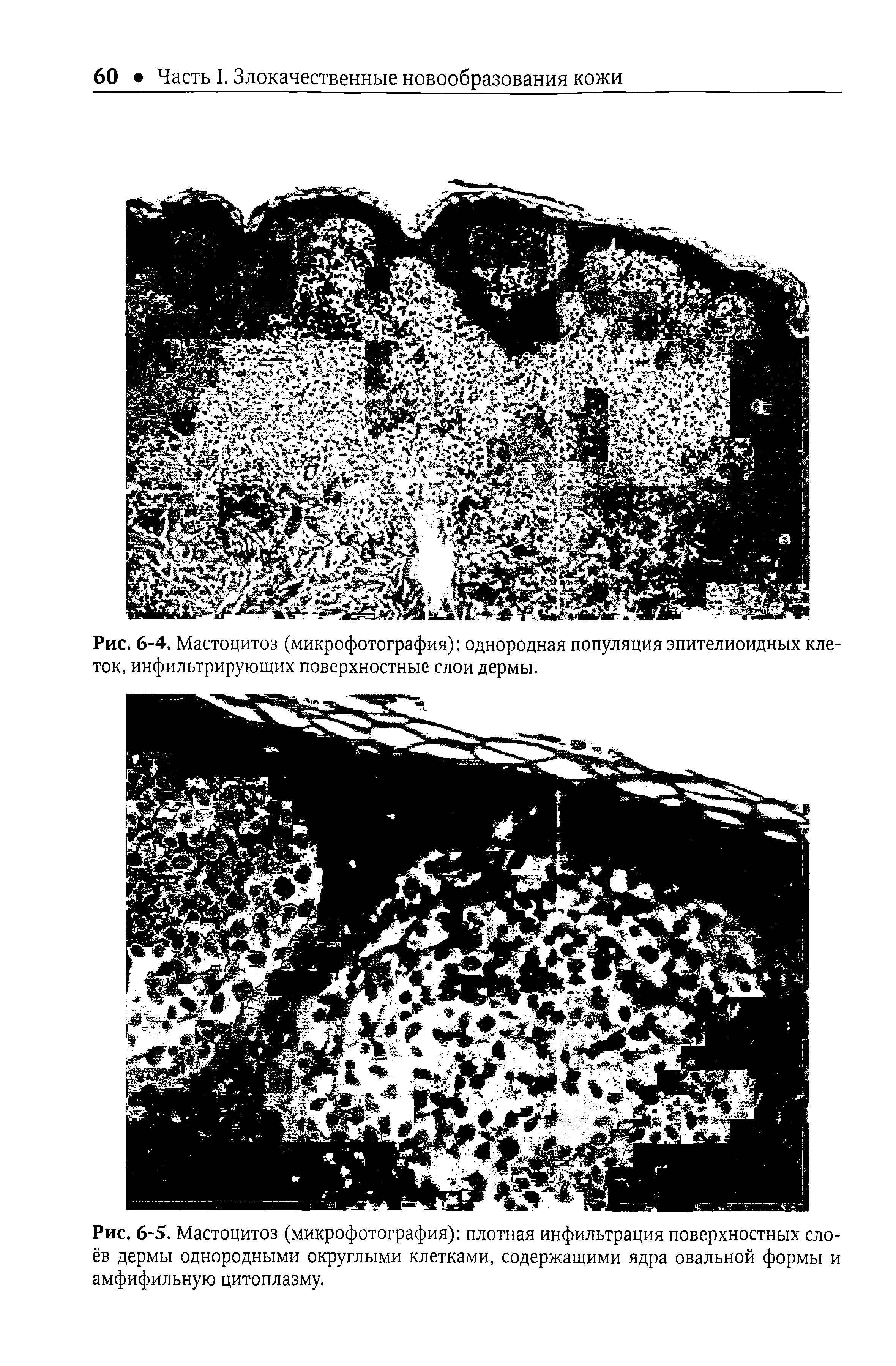 Рис. 6-5. Мастоцитоз (микрофотография) плотная инфильтрация поверхностных слоёв дермы однородными округлыми клетками, содержащими ядра овальной формы и амфифильную цитоплазму.