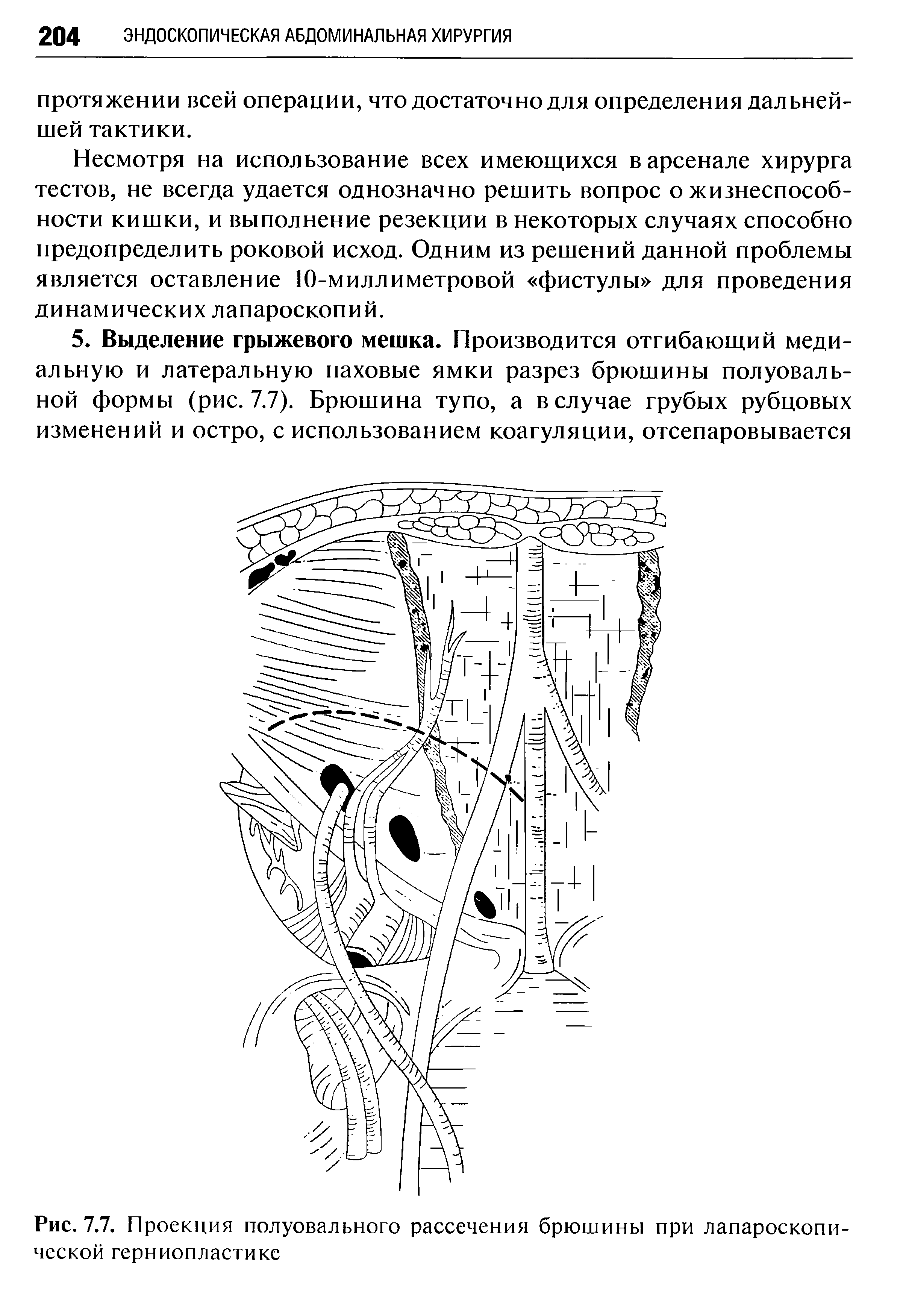 Рис. 7.7. Проекция полуовального рассечения брюшины при лапароскопической герниопластике...