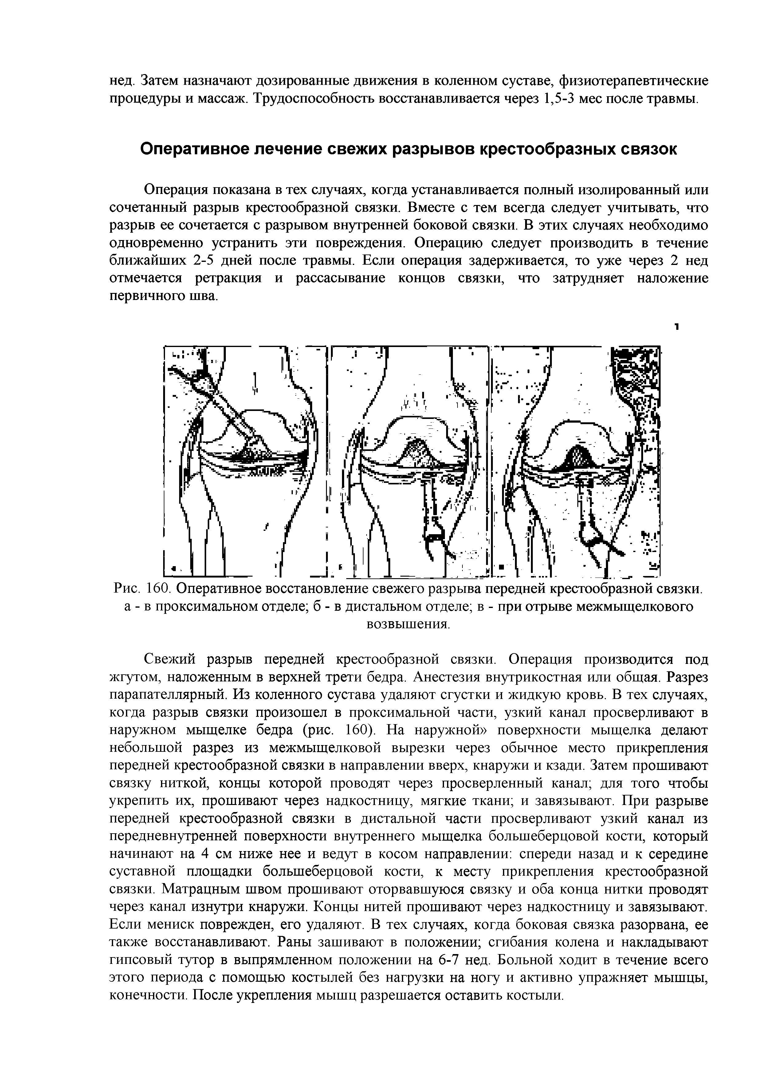 Рис. 160. Оперативное восстановление свежего разрыва передней крестообразной связки, а - в проксимальном отделе б - в дистальном отделе в - при отрыве межмыщелкового возвышения.