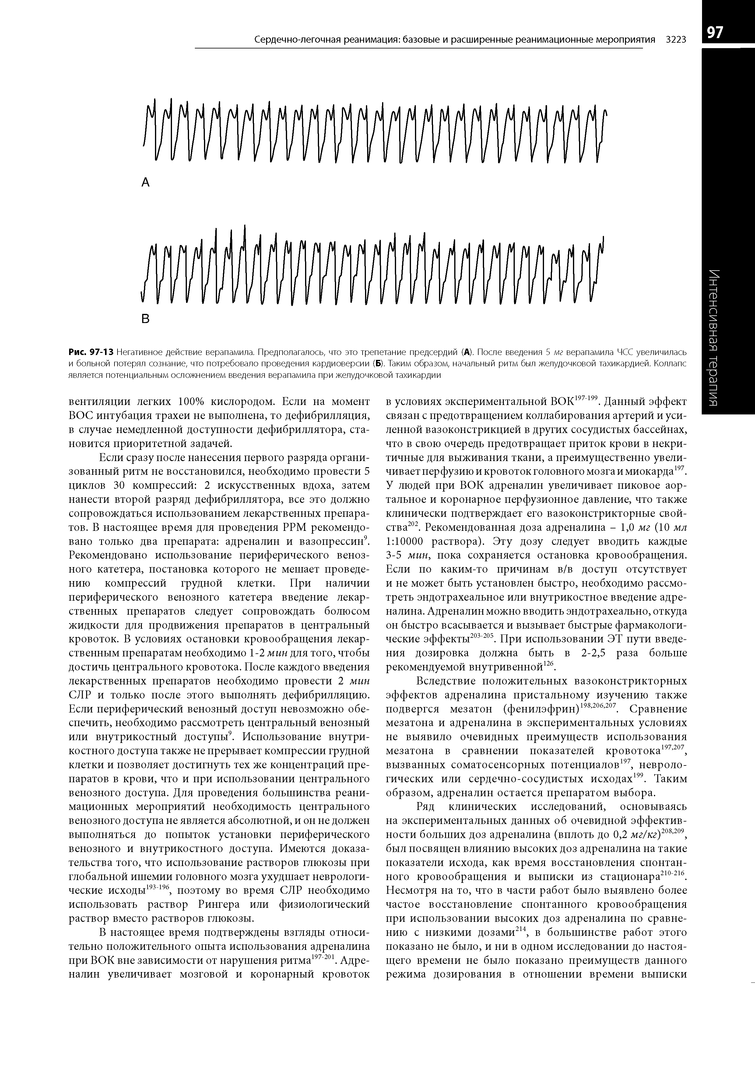 Рис. 97-13 Негативное действие верапамила. Предполагалось, что это трепетание предсердий (А). После введения 5 мг верапамила ЧСС увеличилась и больной потерял сознание, что потребовало проведения кардиоверсии (Б). Таким образом, начальный ритм был желудочковой тахикардией. Коллапс является потенциальным осложнением введения верапамила при желудочковой тахикардии...