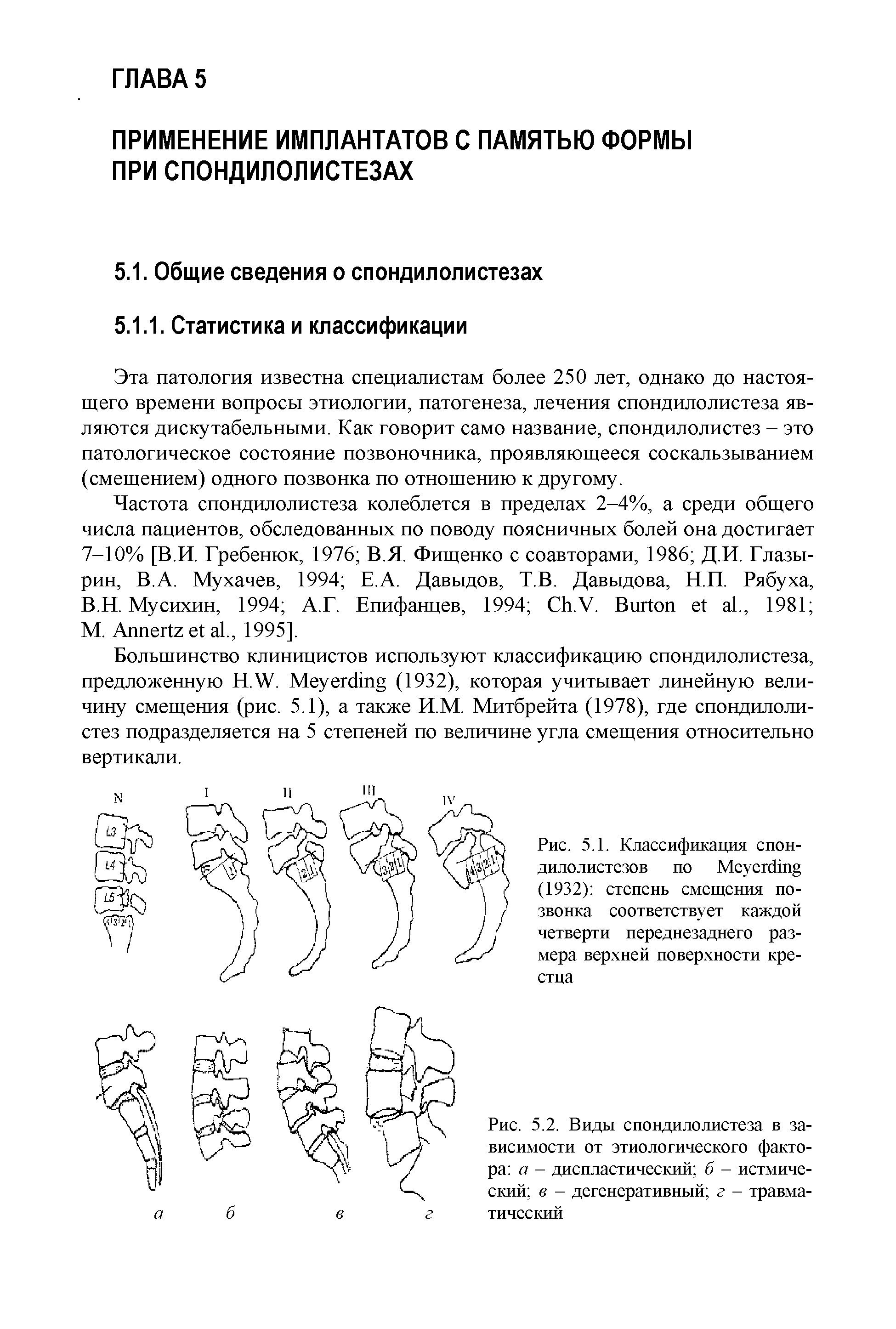 Рис. 5.2. Виды спондилолистеза в зависимости от этиологического фактора а - диспластический б - истмиче-ский в - дегенеративный г - травматический...