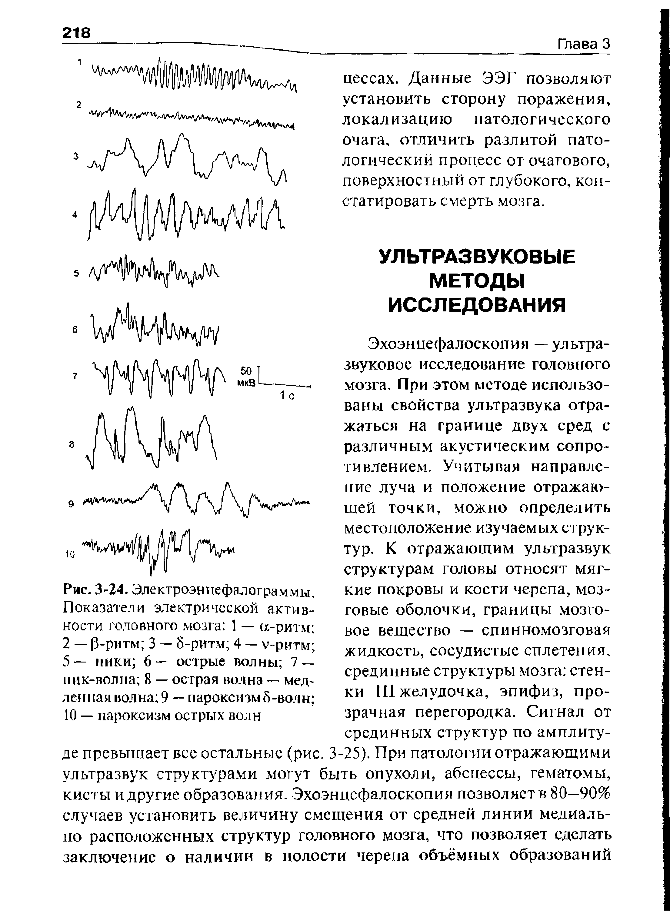 Рис. 3-24. Электроэнцефалограммы. Показатели электрической активности головного мозга 1 — (х-ритм 2 — 3-ритм 3 — 5-ритм 4 — у-ритм 5— пики 6— острые волны 7 — пик-волла 8 — острая волна — медленная волна 9 — пароксизм 5-волн 10 — пароксизм острых волн...