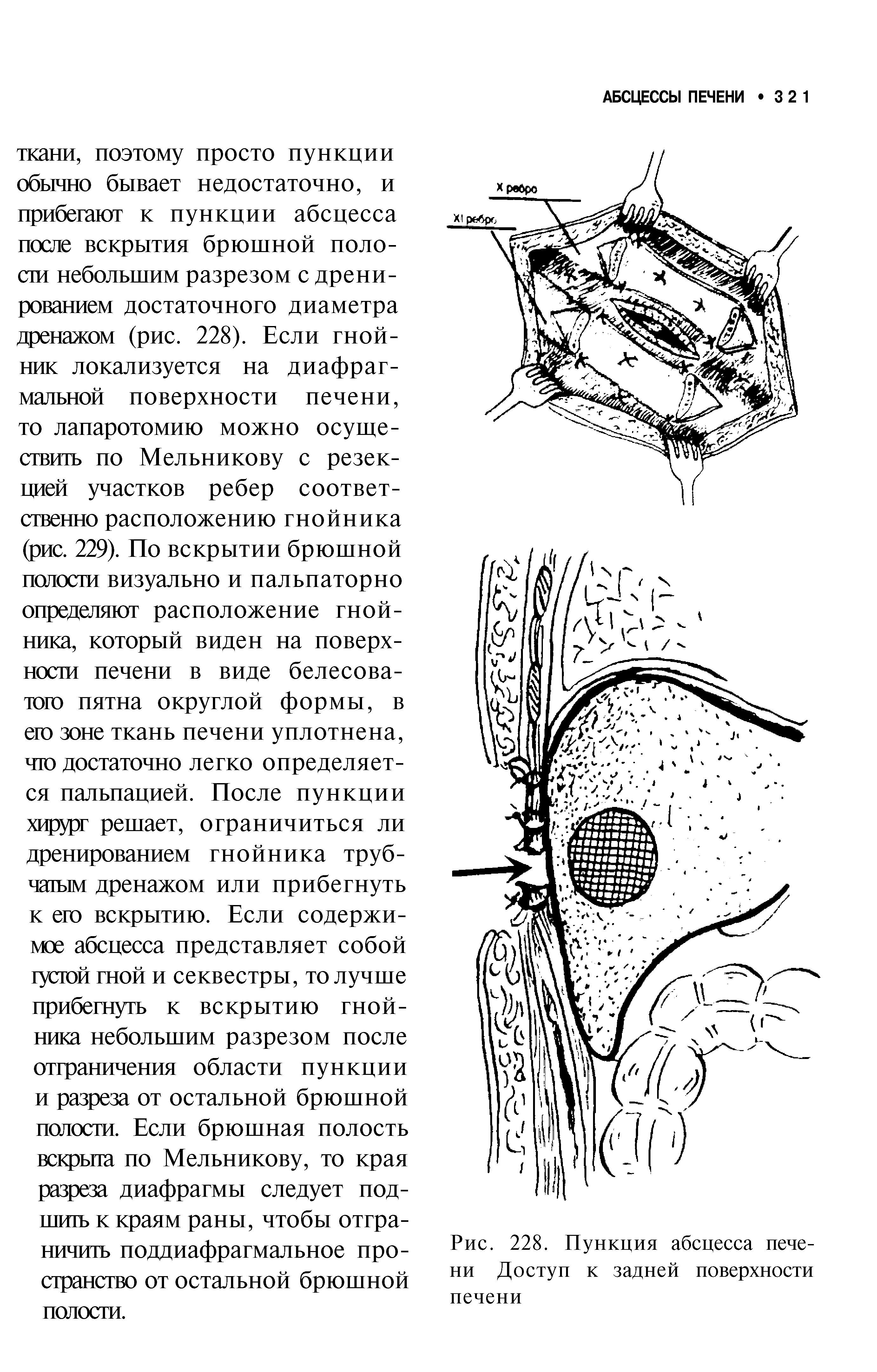Рис. 228. Пункция абсцесса печени Доступ к задней поверхности...