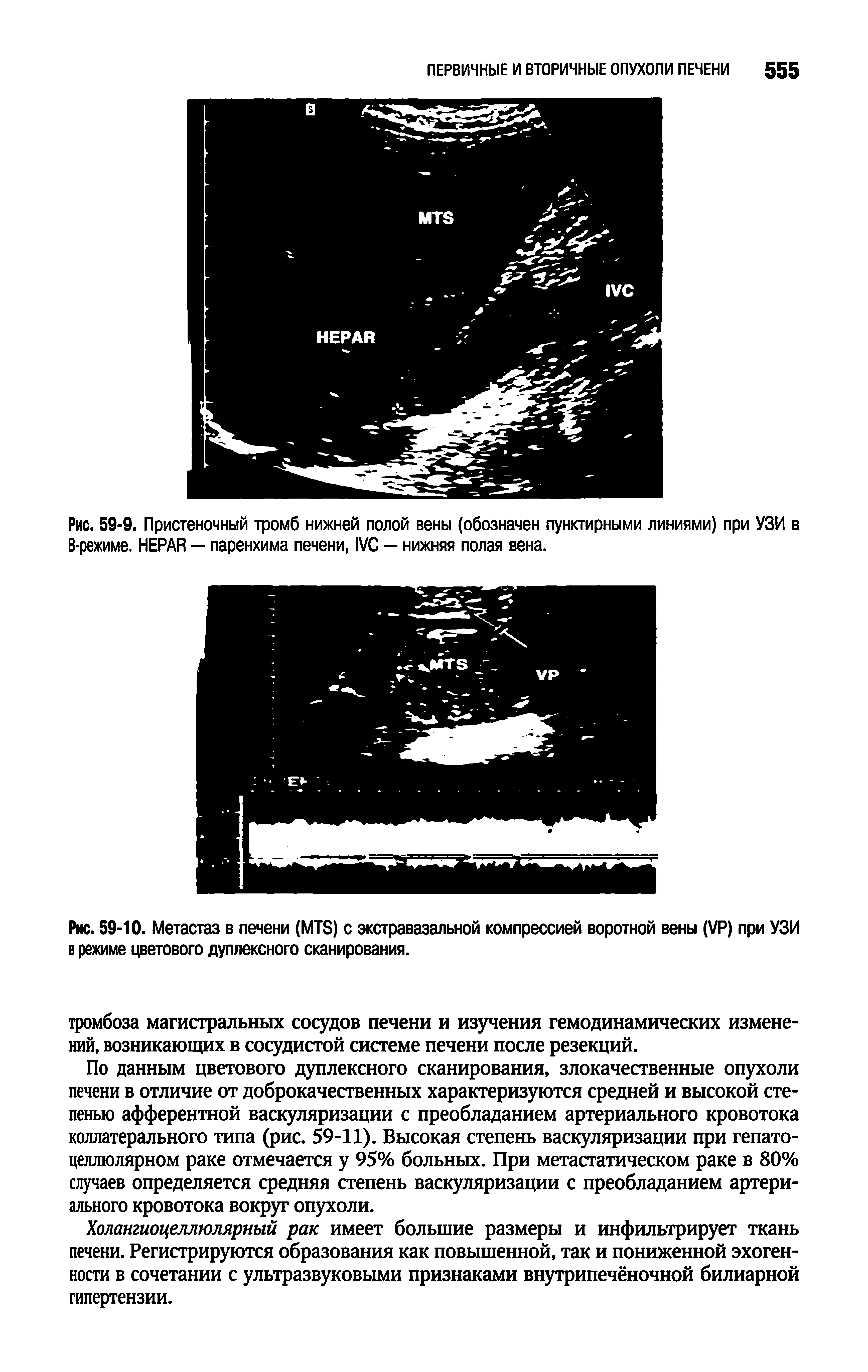 Рис. 59-10. Метастаз в печени (MTS) с экстравазальной компрессией воротной вены (VP) при УЗИ в режиме цветового дуплексного сканирования.