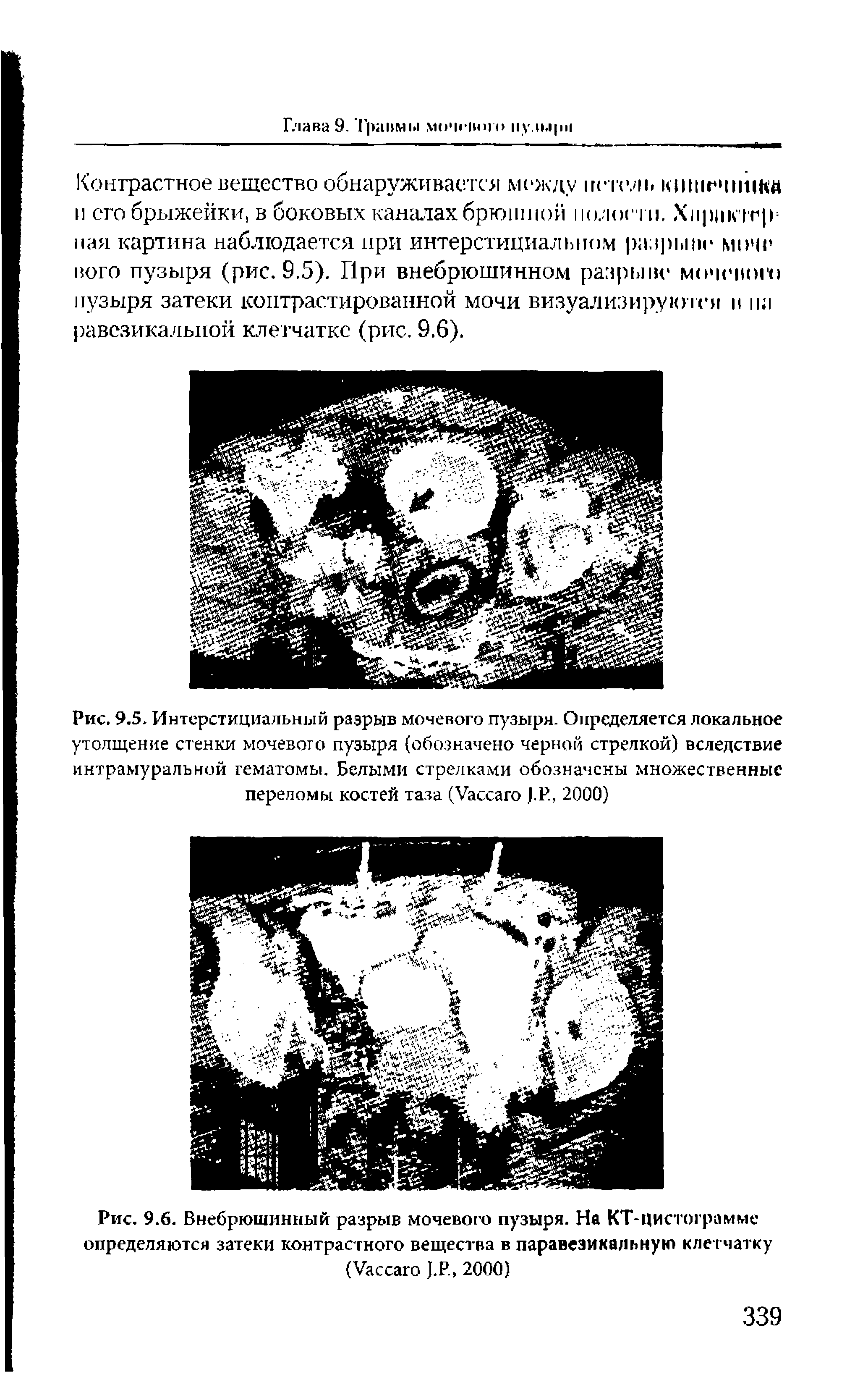 Рис. 9.5. Интерстициальный разрыв мочевого пузыря. Определяется локальное утолщение стенки мочевою пузыря (обозначено черной стрелкой) вследствие интрамуральной гематомы. Белыми стрелками обозначены множественные переломы костей таза (V J.P., 2000)...