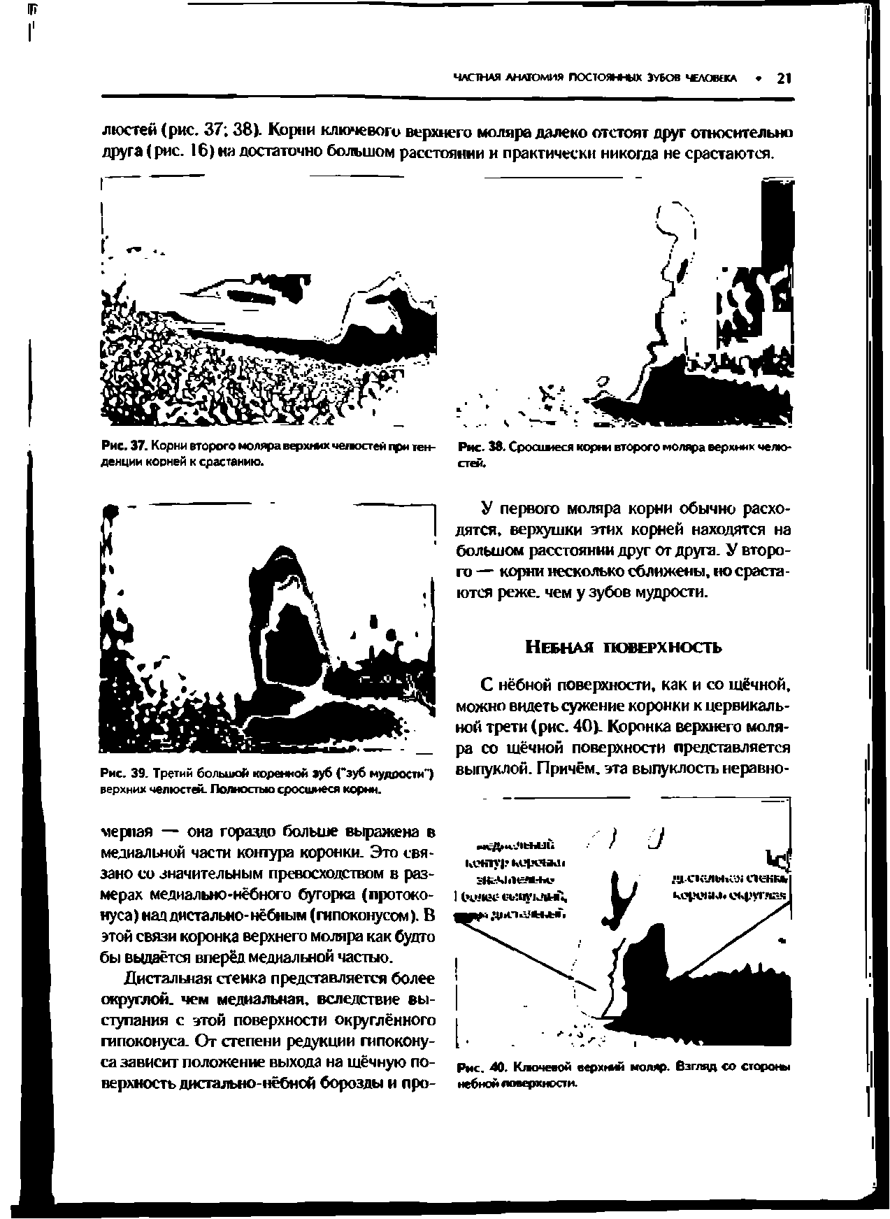 Рис. 39. Третий большой коренной зуб ("зуб мудрости ) верхних челюстей. Полностью сросшиеся корни.