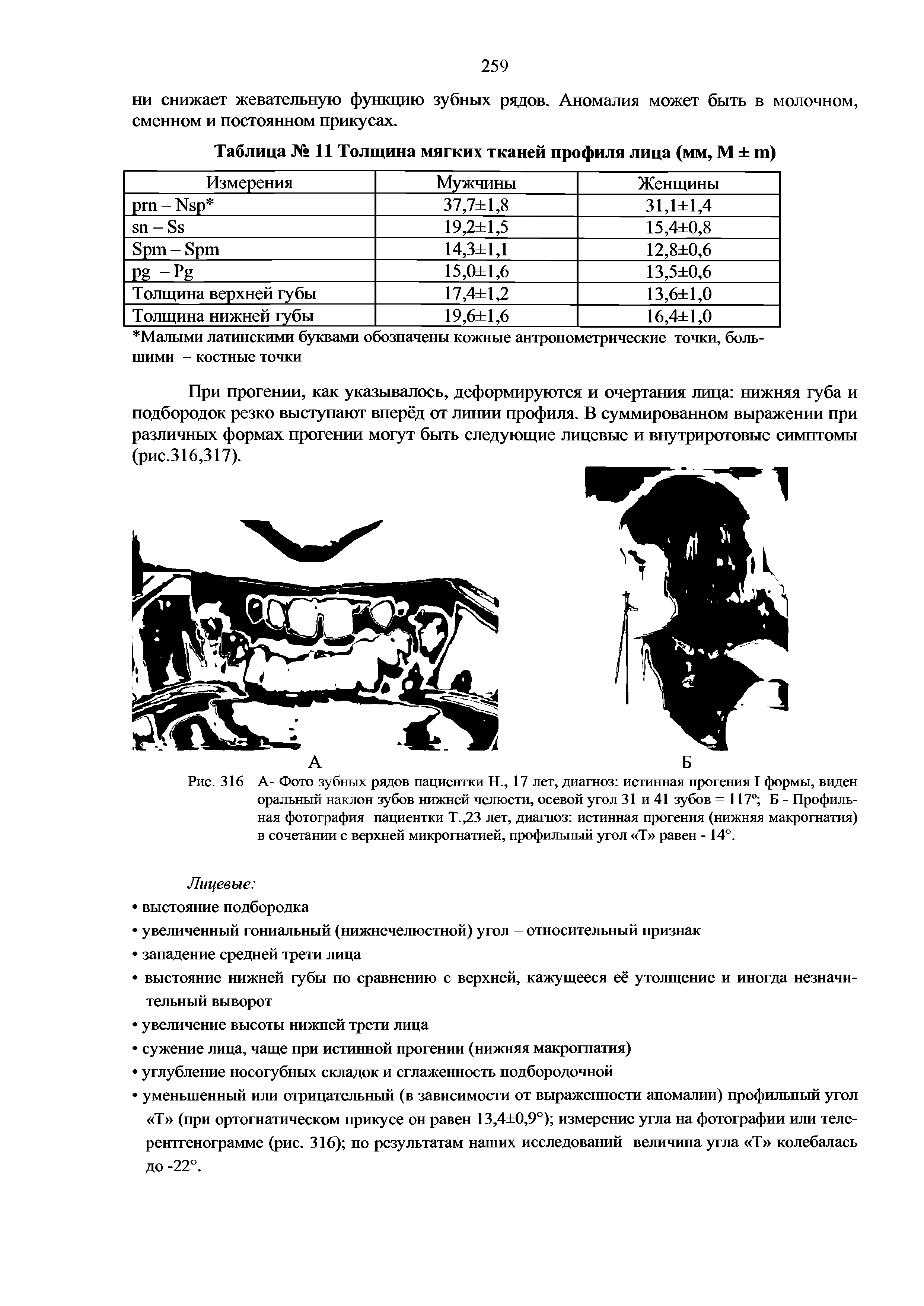 Рис. 316 А- Фото зубных рядов пациентки Н., 17 лет, диагноз истинная прогения I формы, виден оральный наклон зубов нижней челюсти, осевой угол 31 и 41 зубов =117° Б - Профильная фотография пациентки Т.,23 лет, диагноз истинная прогения (нижняя макрогнатия) в сочетании с верхней микрогнатией, профильный угол Т равен - 14°.