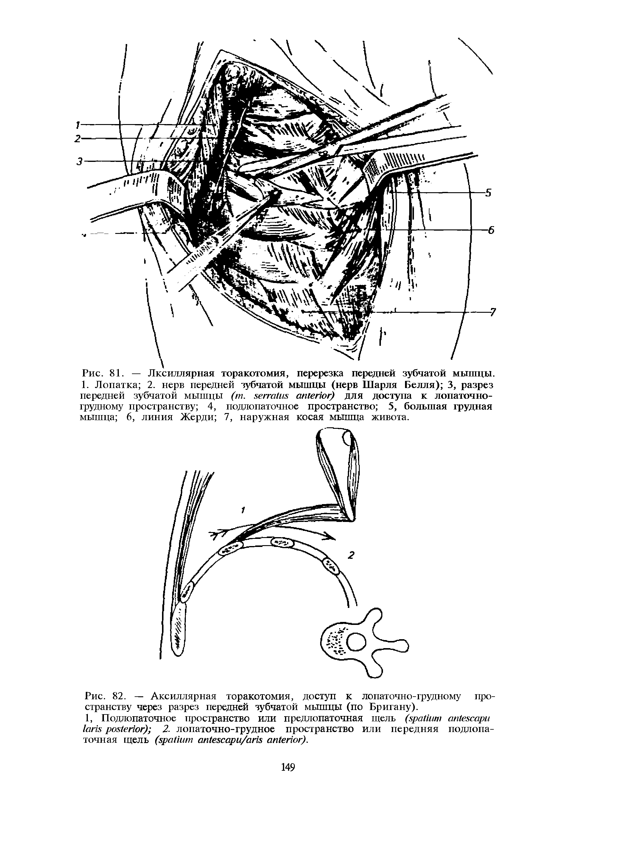 Рис. 82. — Аксиллярная торакотомия, доступ к лопаточно-грудному пространству через разрез передней зубчатой мышцы (по Бр игану).