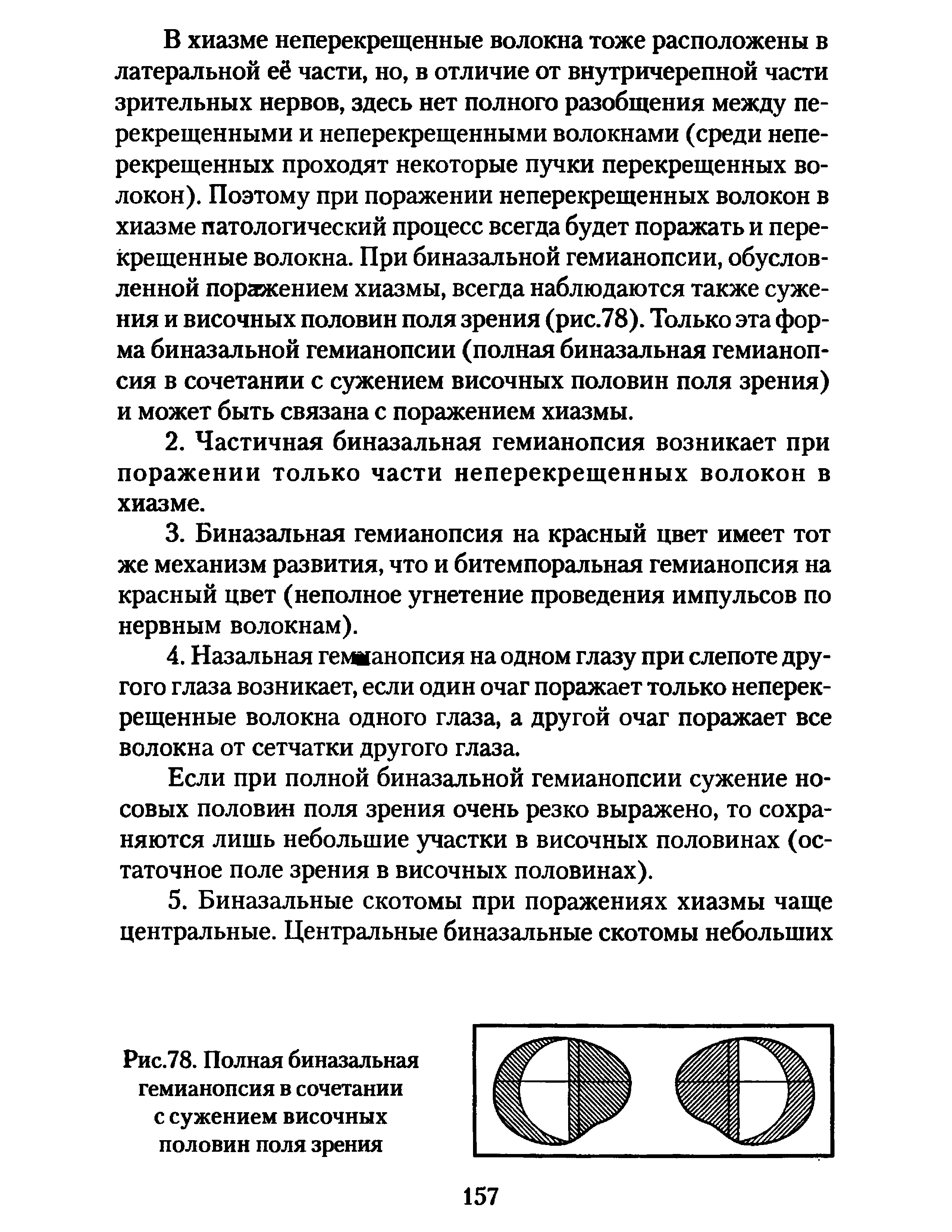 Рис.78. Полная биназальная гемианопсия в сочетании с сужением височных половин поля зрения...