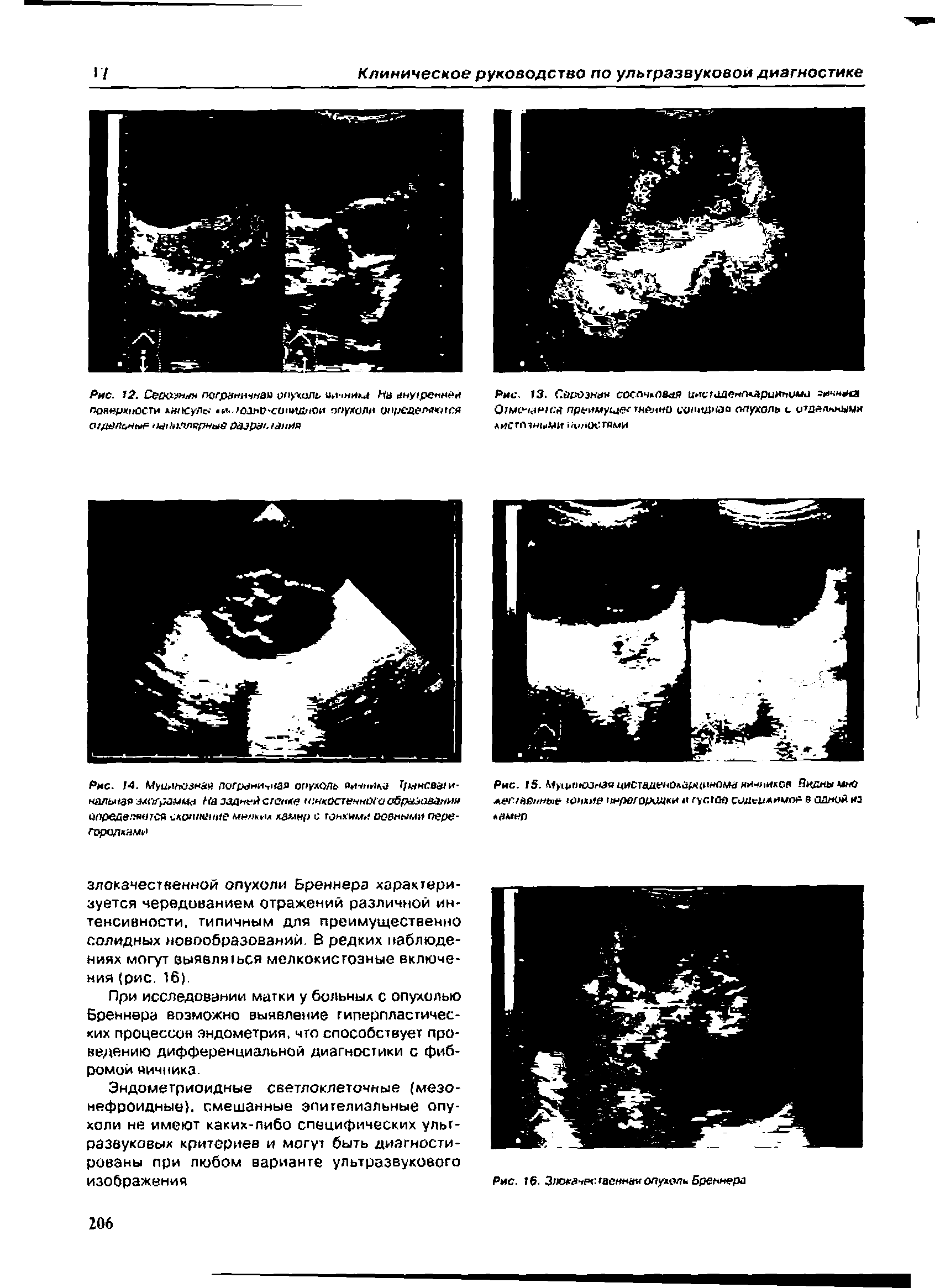 Рис. 14. Муц> ъазнйч пограничная опухоль яичника Т/мнса и-нальная эмг амма На задней сгенхе ч .икостаннтхос рамаамня опредепяеюя скопление мннки камер с гонкими ооаными перегородками...