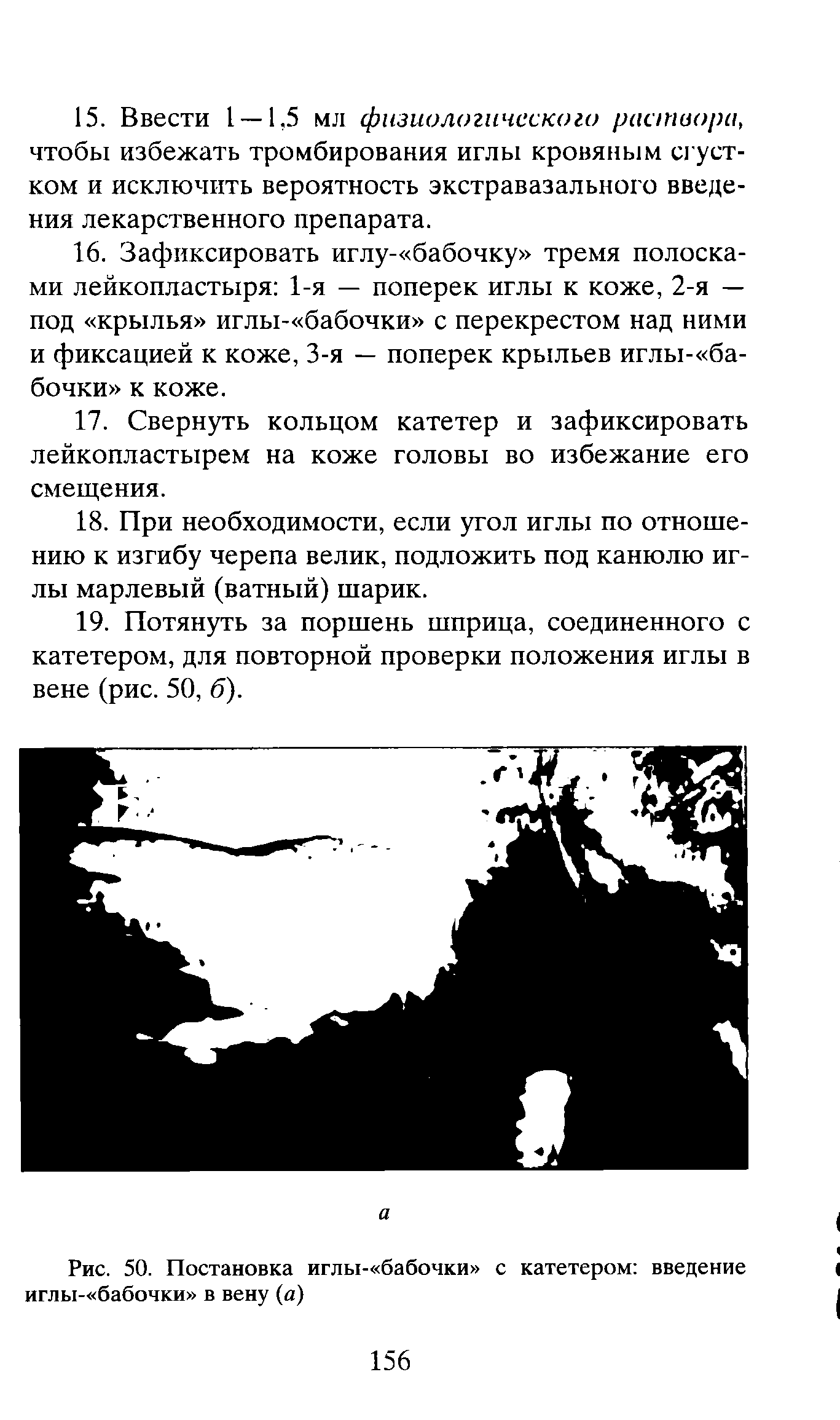 Рис. 50. Постановка иглы- бабочки с катетером введение иглы- бабочки в вену (а)...