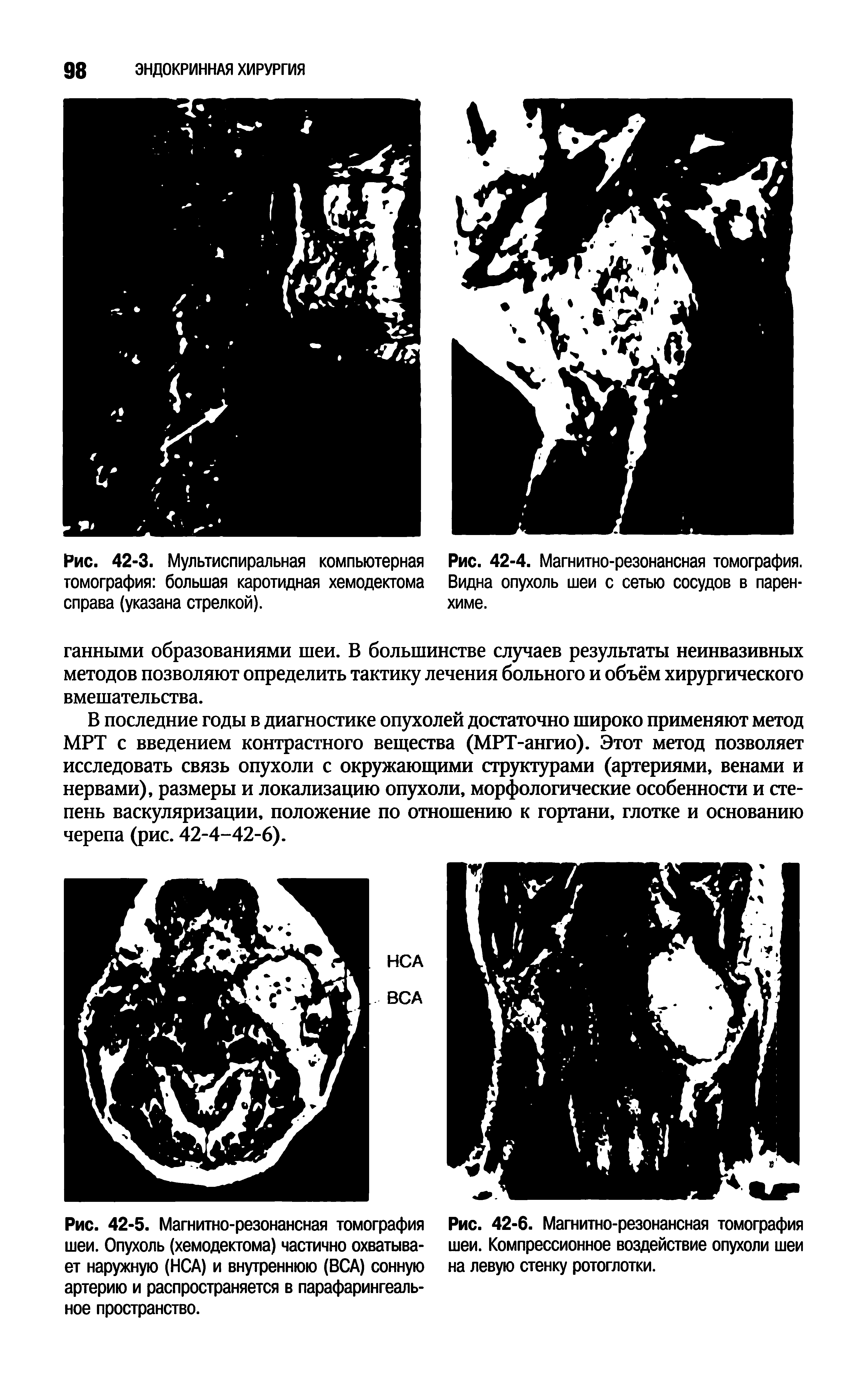 Рис. 42-6. Магнитно-резонансная томография шеи. Компрессионное воздействие опухоли шеи на левую стенку ротоглотки.