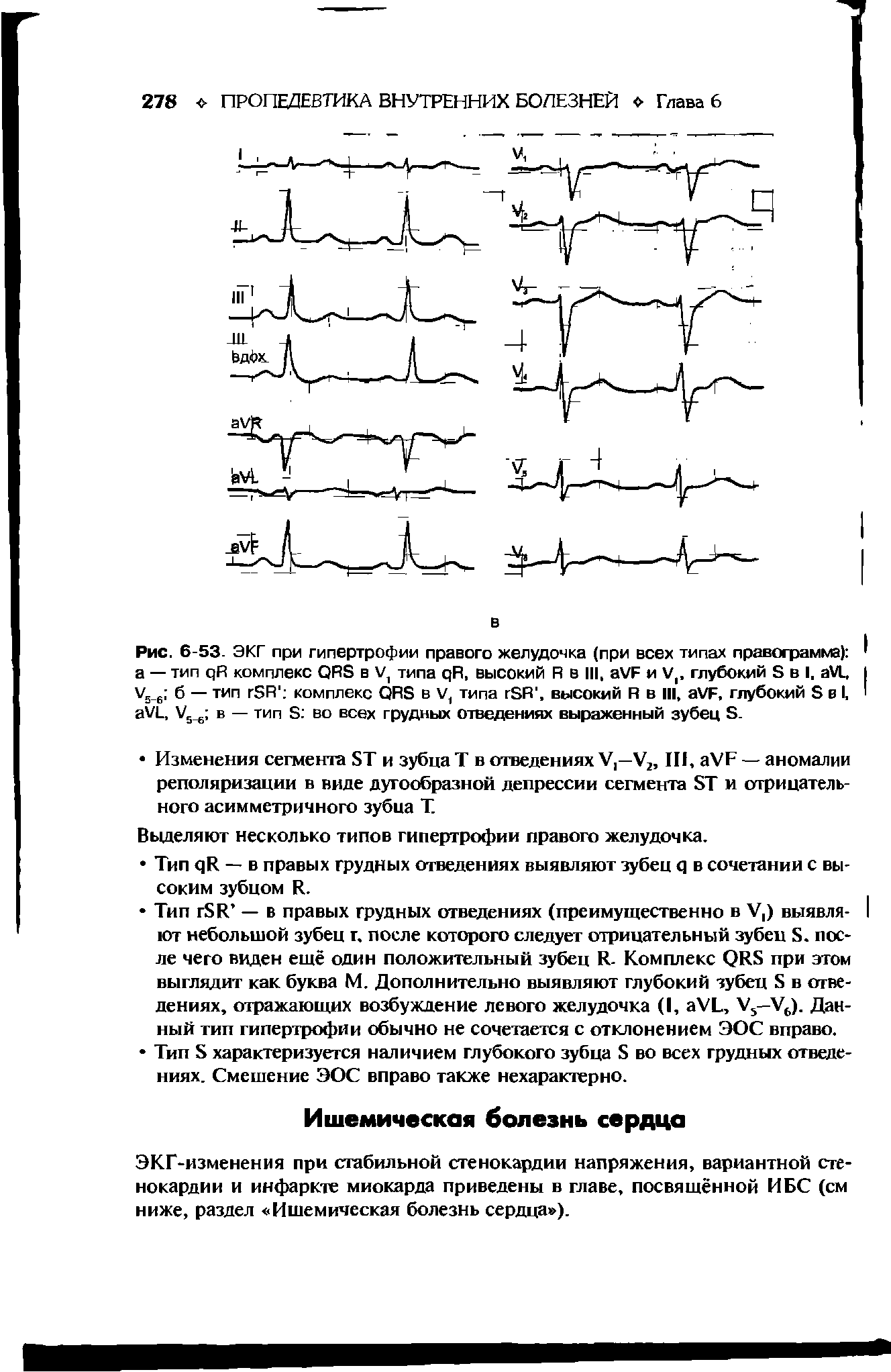 Рис. 6-53. ЭКГ при гипертрофии правого желудочка (при всех типах правограмма) а — тип цЯ комплекс в V, типа цР, высокий Я в III, аУР и V, глубокий Б в I, аУС, У5 6 б — тип гЭЯ комплекс ОЯв в V, типа гБР, высокий Я в III, аХ/Б, глубокий Б в I, аУ1, У5 6 в — тип Б во всех грудных отведениях выраженный зубец Б.