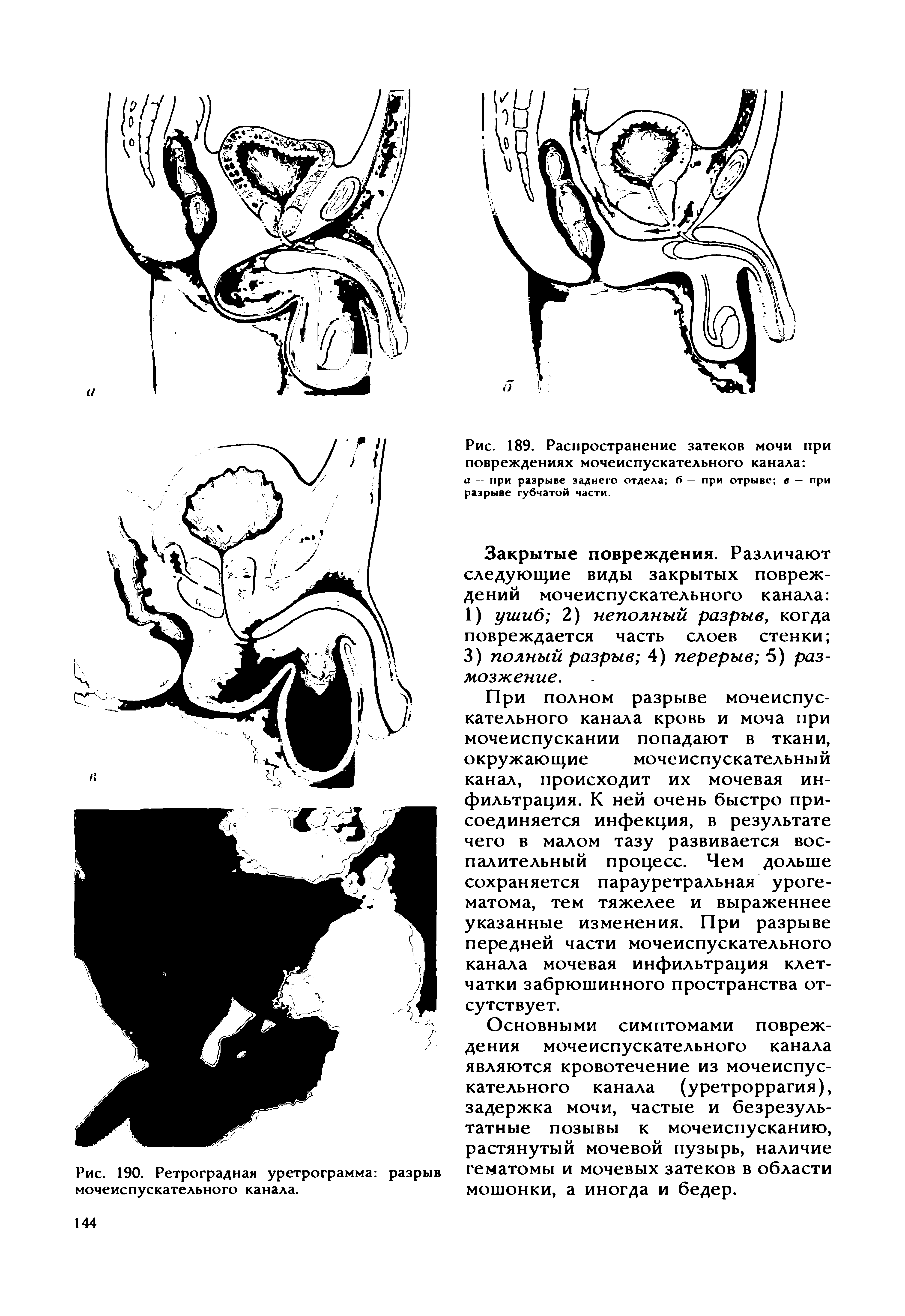 Рис. 189. Распространение затеков мочи при повреждениях мочеиспускательного канала а — при разрыве заднего отдела 6 — при отрыве в — при разрыве губчатой части.