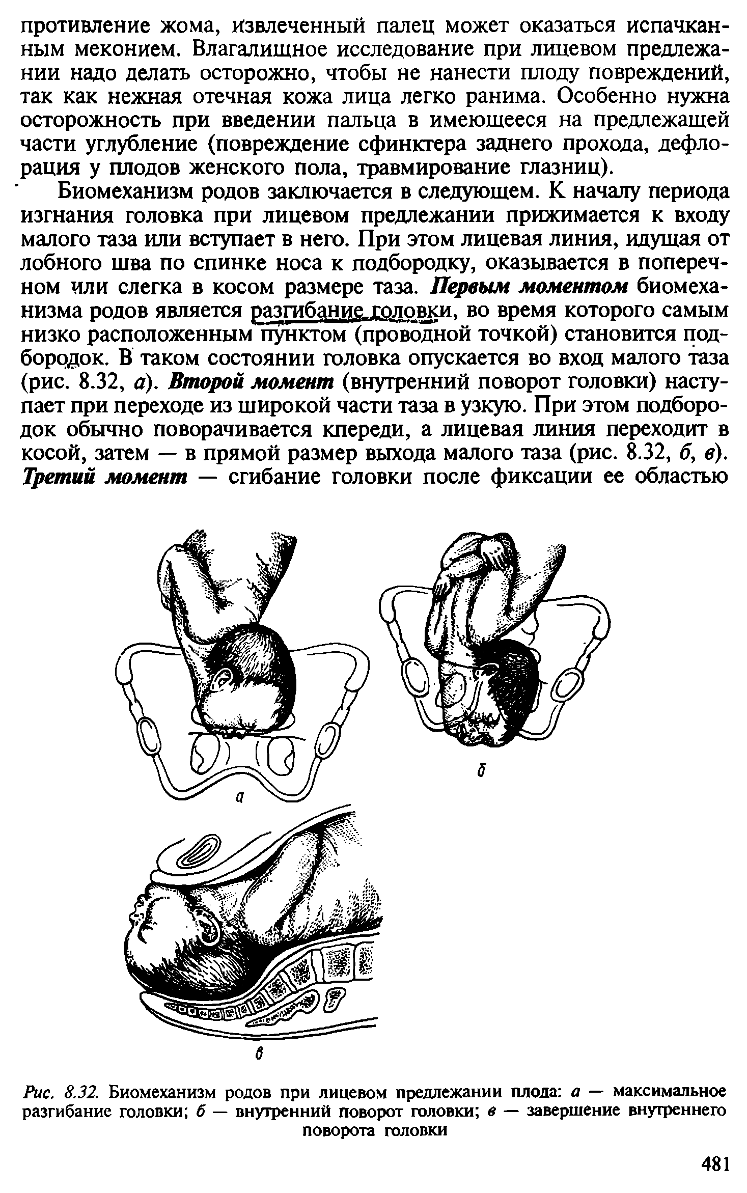 Рис. 8.32. Биомеханизм родов при лицевом предлежании плода а — максимальное разгибание головки б — внутренний поворот головки в — завершение внутреннего поворота головки...